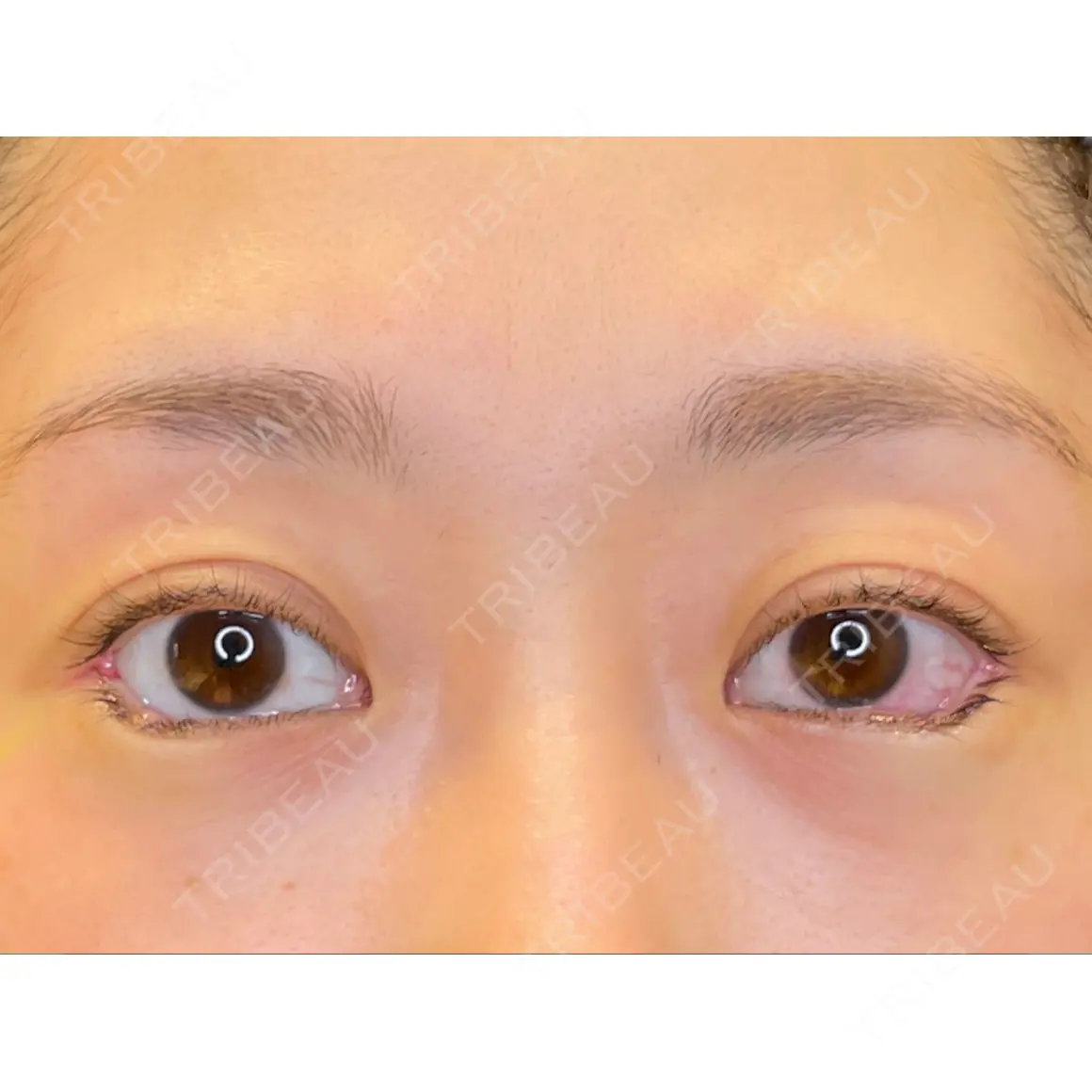 目尻切開 / タレ目形成・グラマラスライン（埋没） / その他（肌） LOUIS CLINIC 二子玉川院【ルイクリニック】 DAY 0