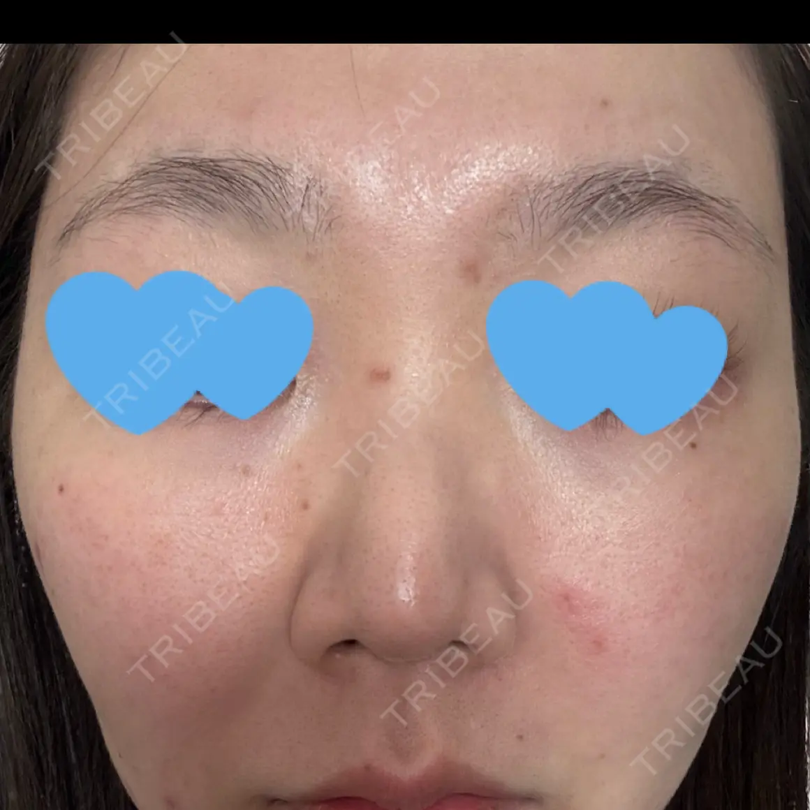 光治療（フォトフェイシャルなど） まゆりなclinic 名古屋栄 DAY 0
