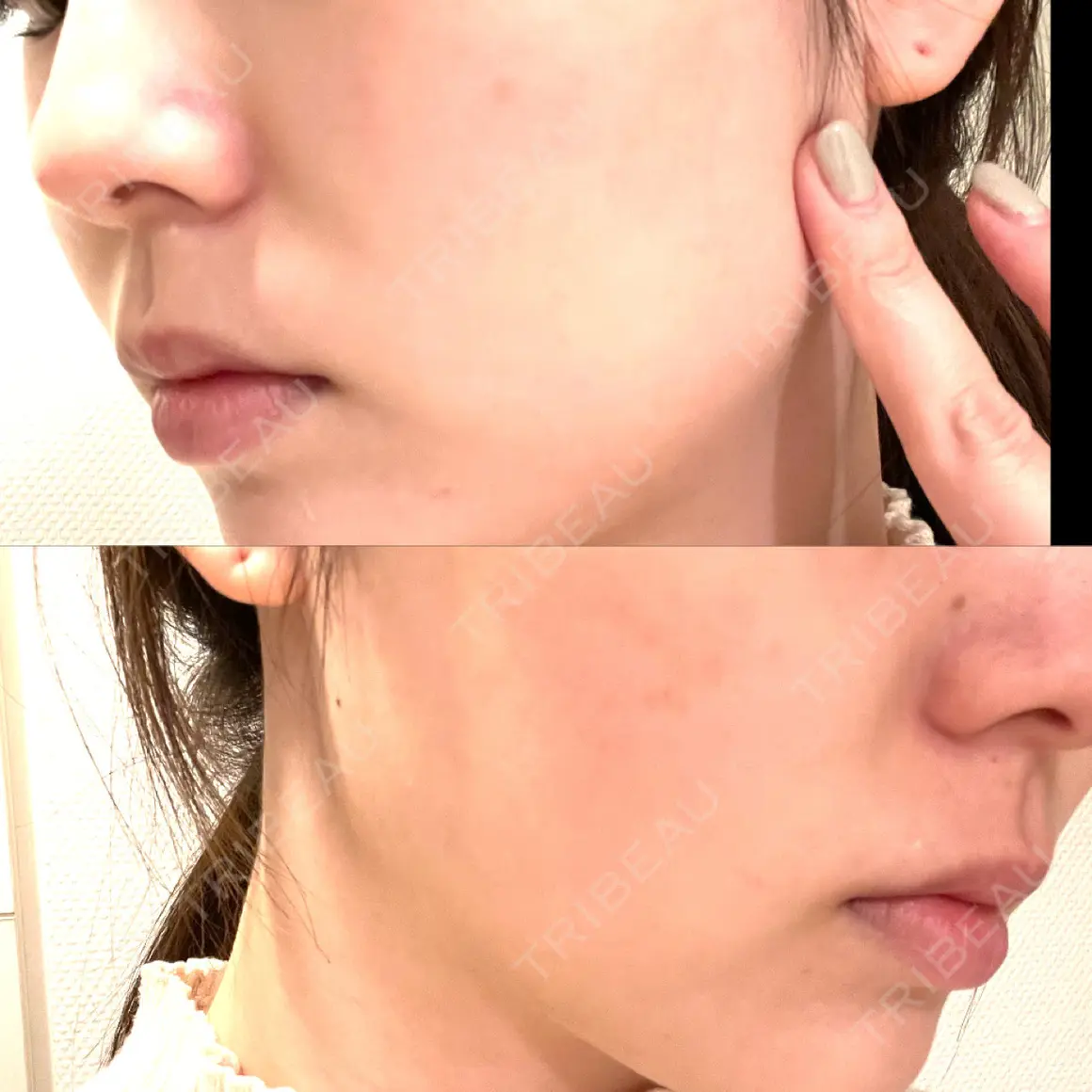 その他（輪郭） パールスキンクリニック天神 AFTER
