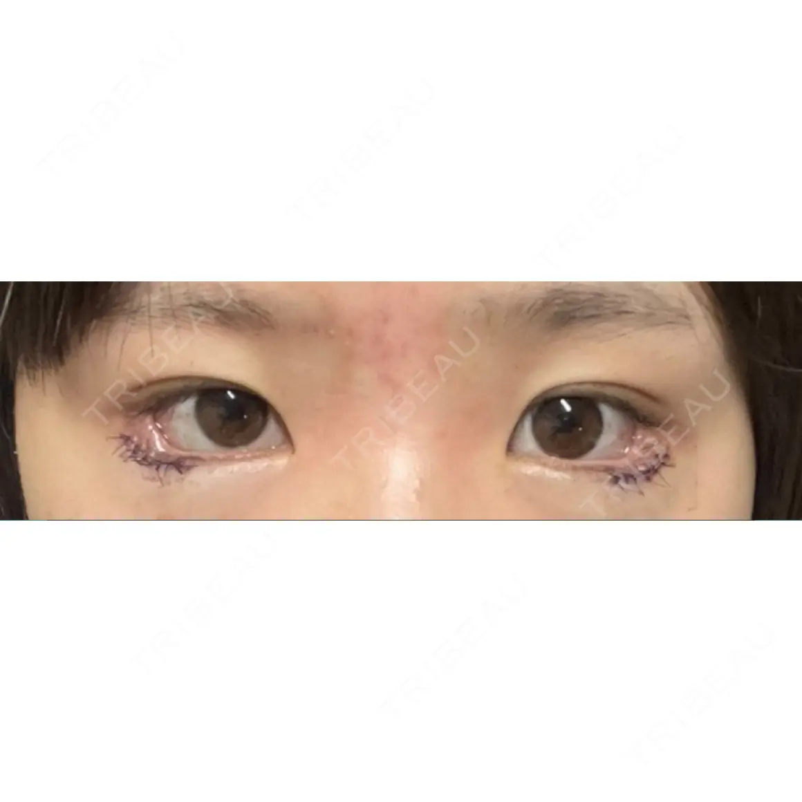 タレ目形成・グラマラスライン（切開） プロミス整形外科 DAY 0