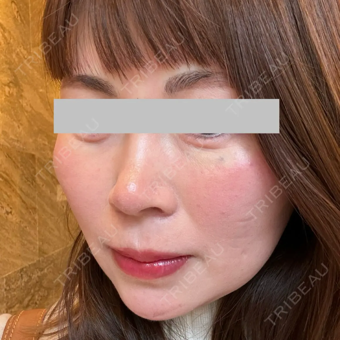 ヒアルロン酸注入（涙袋） / ボトックス（眉間） / ボトックス（目尻） ルラ美容クリニック 神戸院 AFTER