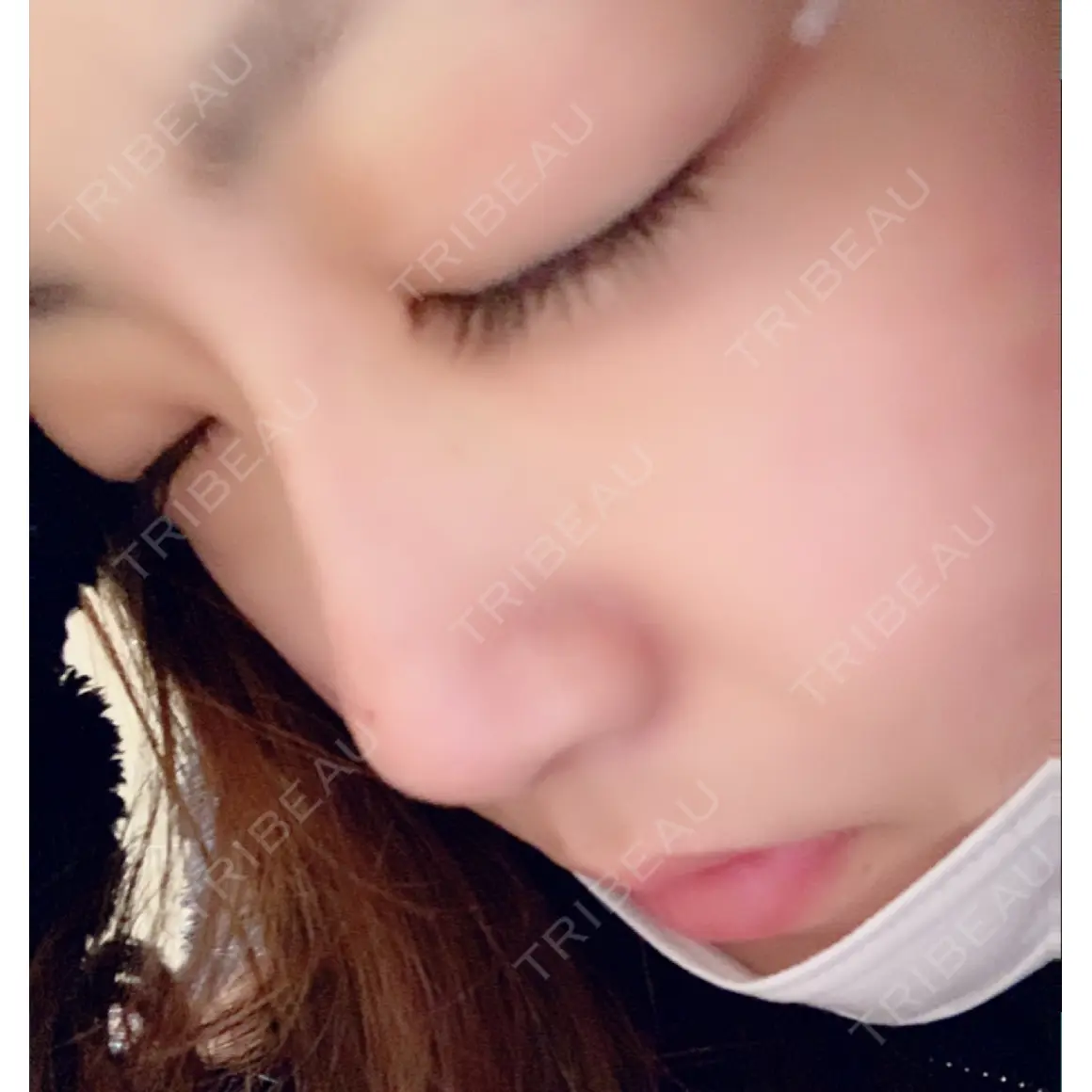 ヒアルロン酸注入（鼻） トアロード形成美容クリニック DAY 0