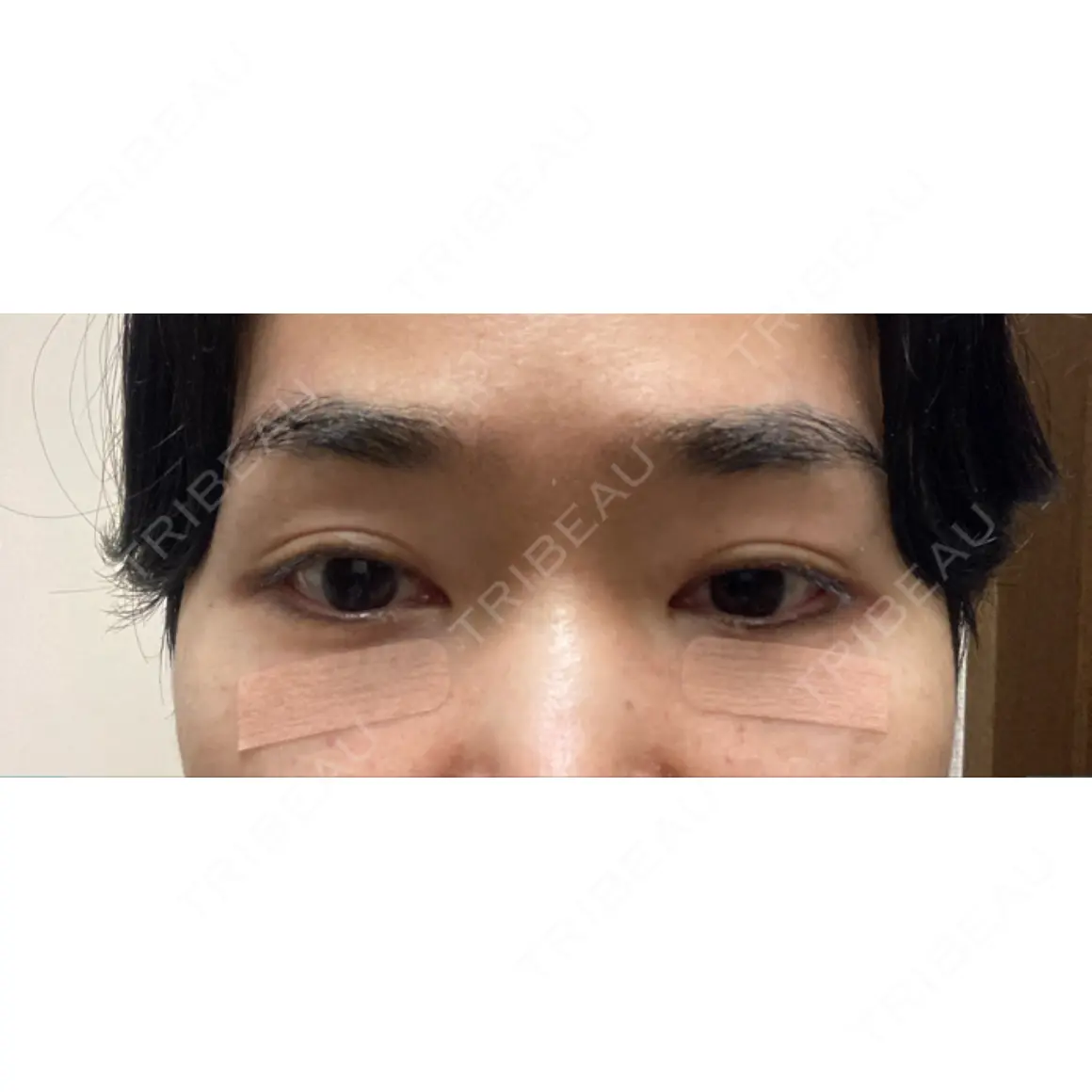 クマ治療 / 下まぶたたるみ取り / 下まぶたの脂肪取り 東京イセアクリニック DAY 0