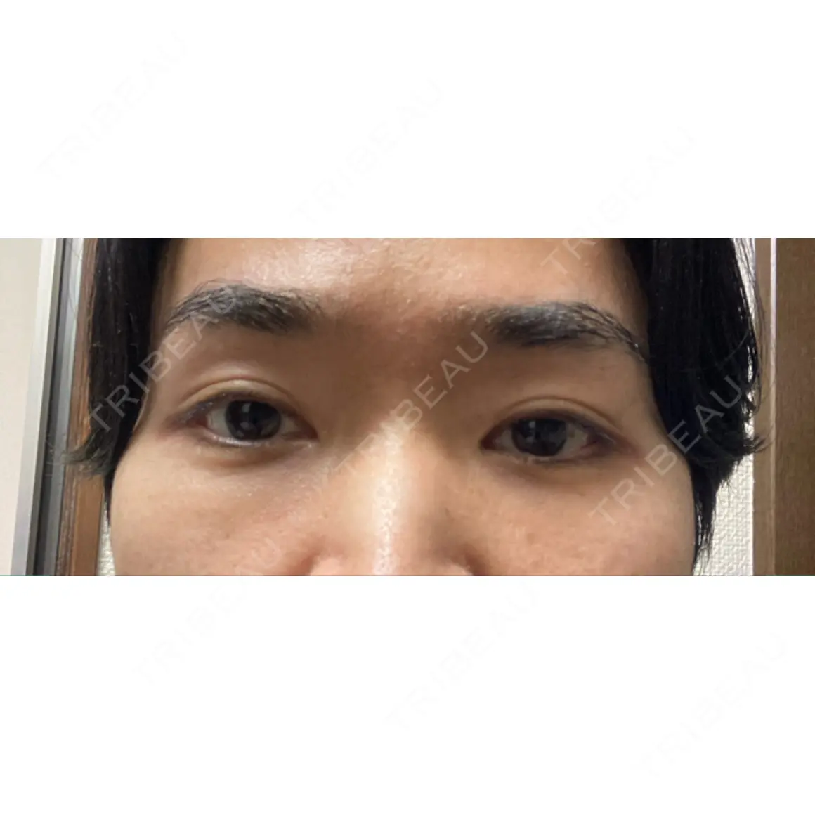 クマ治療 / 下まぶたたるみ取り / 下まぶたの脂肪取り 東京イセアクリニック AFTER