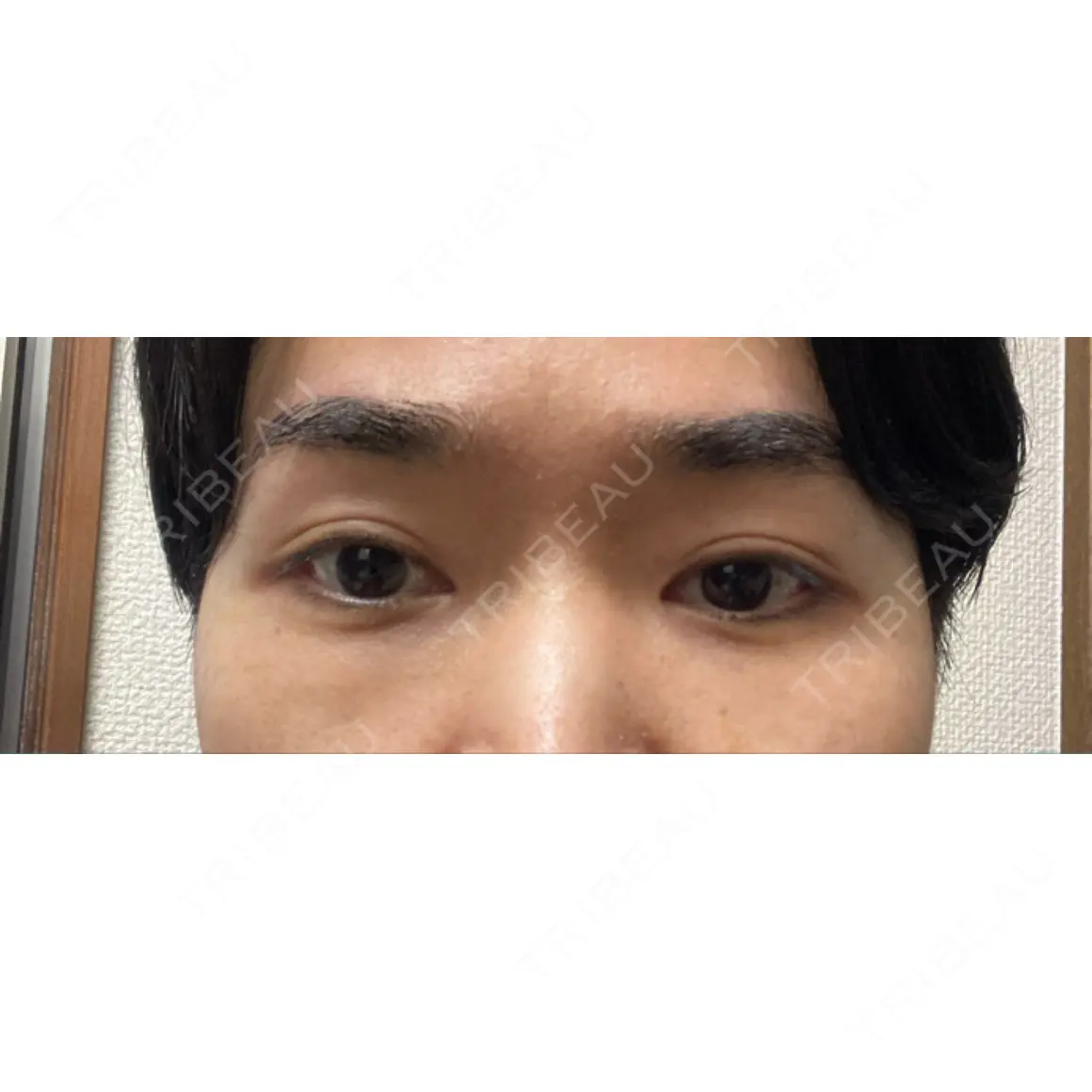 クマ治療 / 下まぶたたるみ取り / 下まぶたの脂肪取り 東京イセアクリニック AFTER