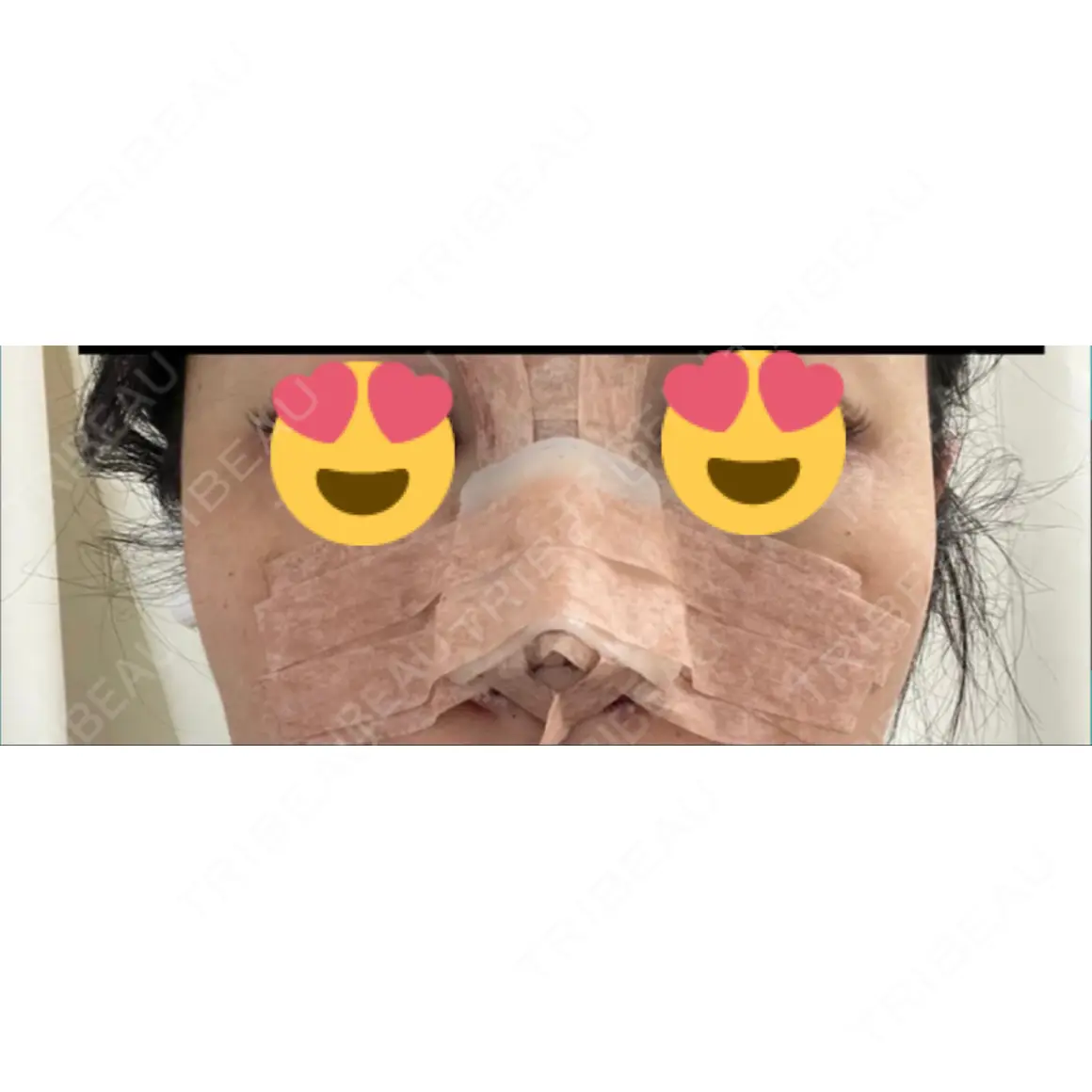 隆鼻術 / 鼻尖形成（切開） / 軟骨移植 / 鼻柱下降・鼻唇角形成（猫手術） / その他（鼻） グローバルビューティークリニック 大阪院 DAY 0