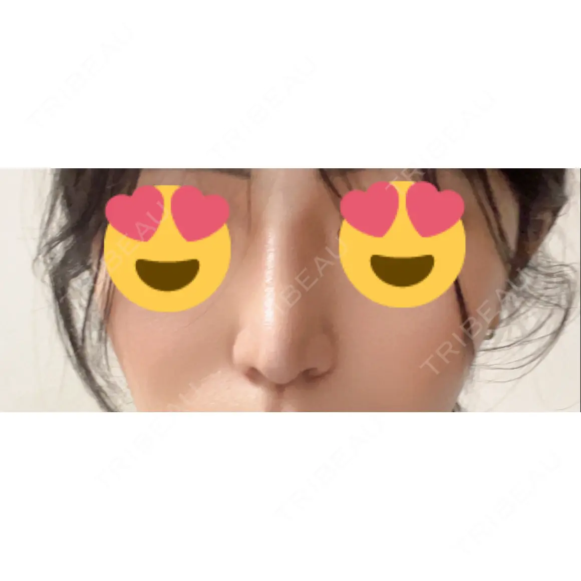 隆鼻術 / 鼻尖形成（切開） / 軟骨移植 / 鼻柱下降・鼻唇角形成（猫手術） / その他（鼻） グローバルビューティークリニック 大阪院 AFTER