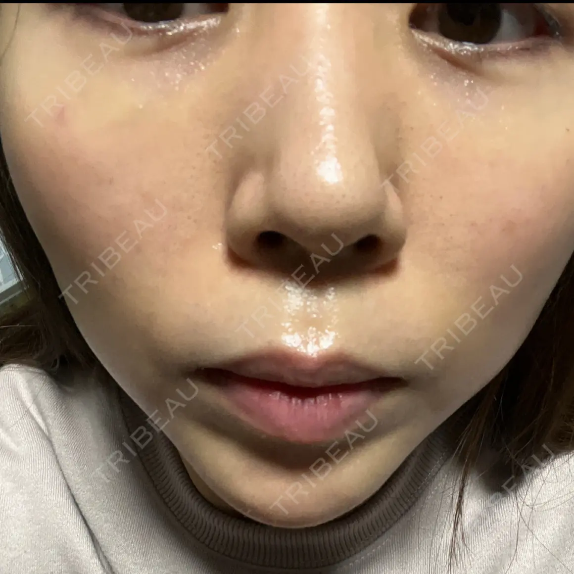 肌ヒアルロン酸注入（たるみ・シワ改善） BAO CLINIC 心斎橋院 AFTER