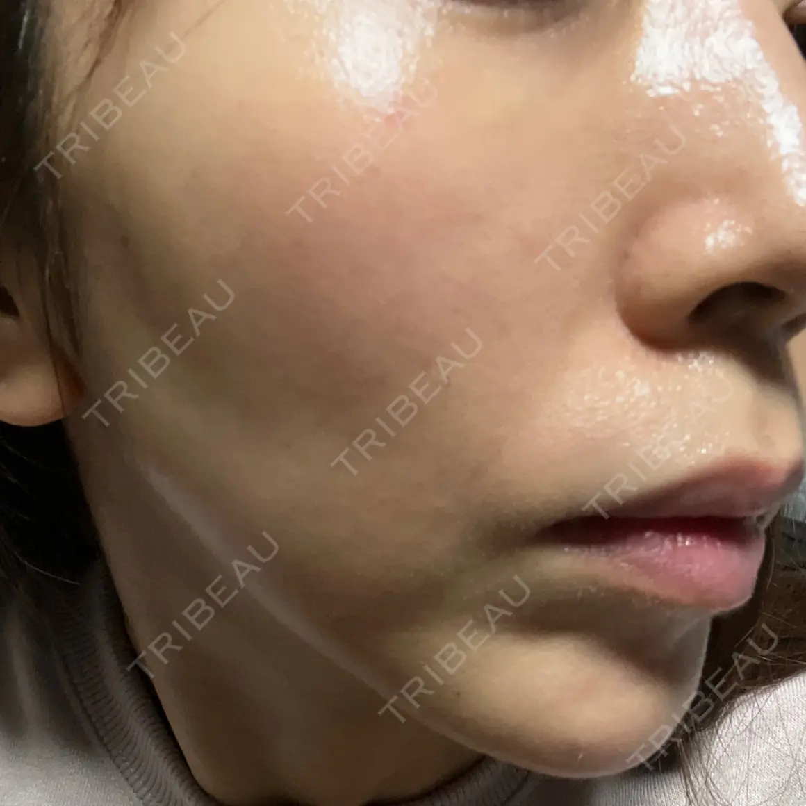 肌ヒアルロン酸注入（たるみ・シワ改善） BAO CLINIC 心斎橋院 AFTER