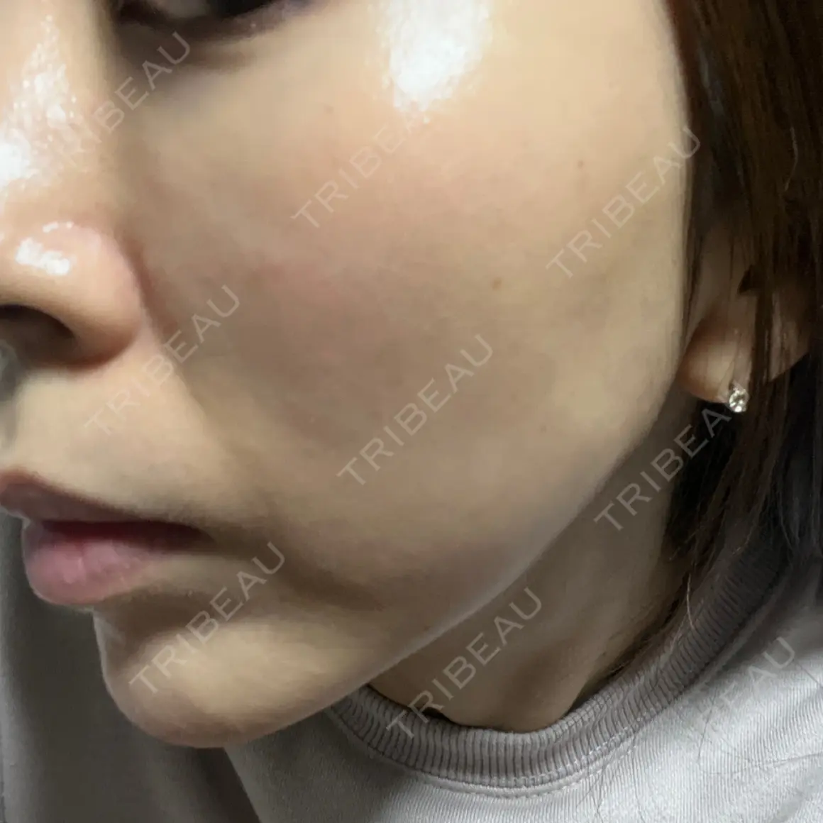 肌ヒアルロン酸注入（たるみ・シワ改善） BAO CLINIC 心斎橋院 AFTER