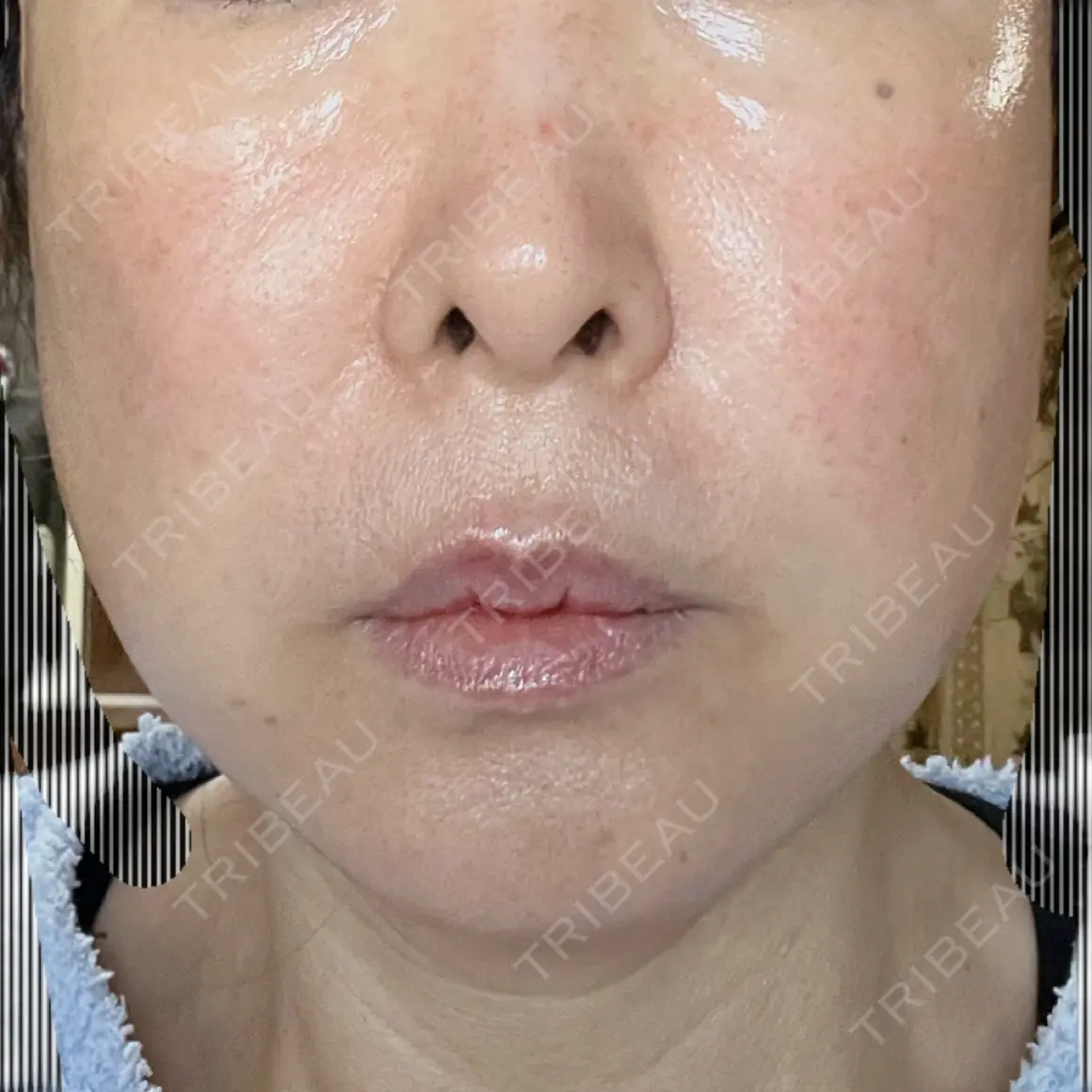 切開リフト かわた美容クリニック AFTER