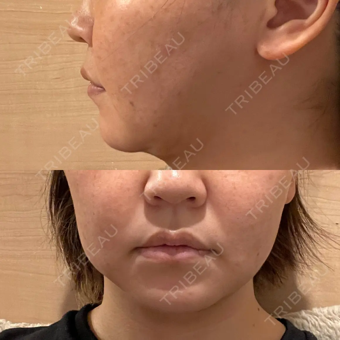 脂肪吸引（顔） / ヒアルロン酸注入（あご） / ボトックス（エラ・小顔） Mods Clinic（モッズクリニック） 大阪院 DAY 31