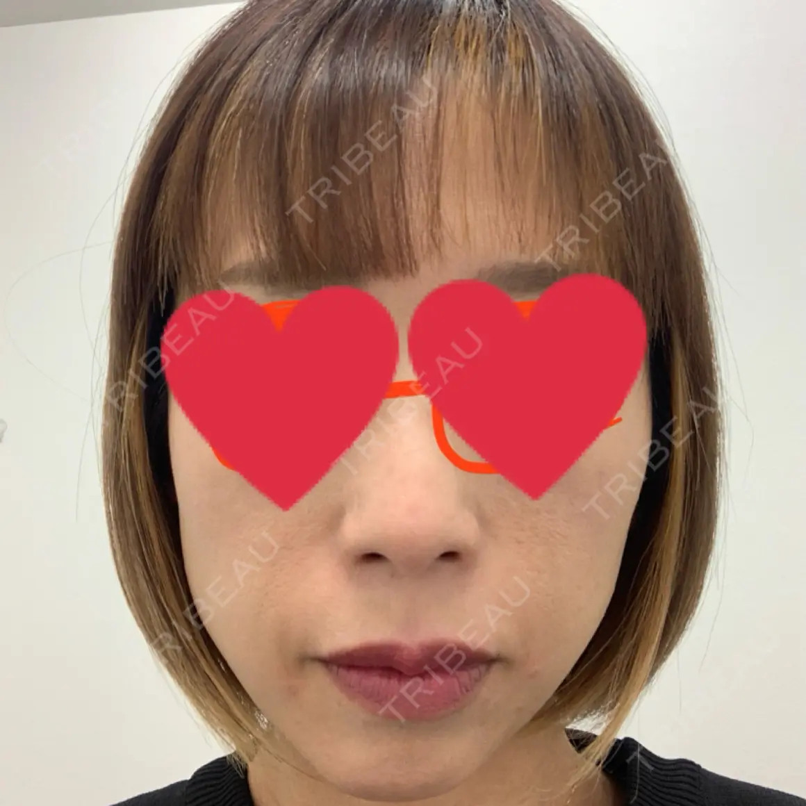 肌ヒアルロン酸注入（たるみ・シワ改善） TCB東京中央美容外科 松江院 DAY 0