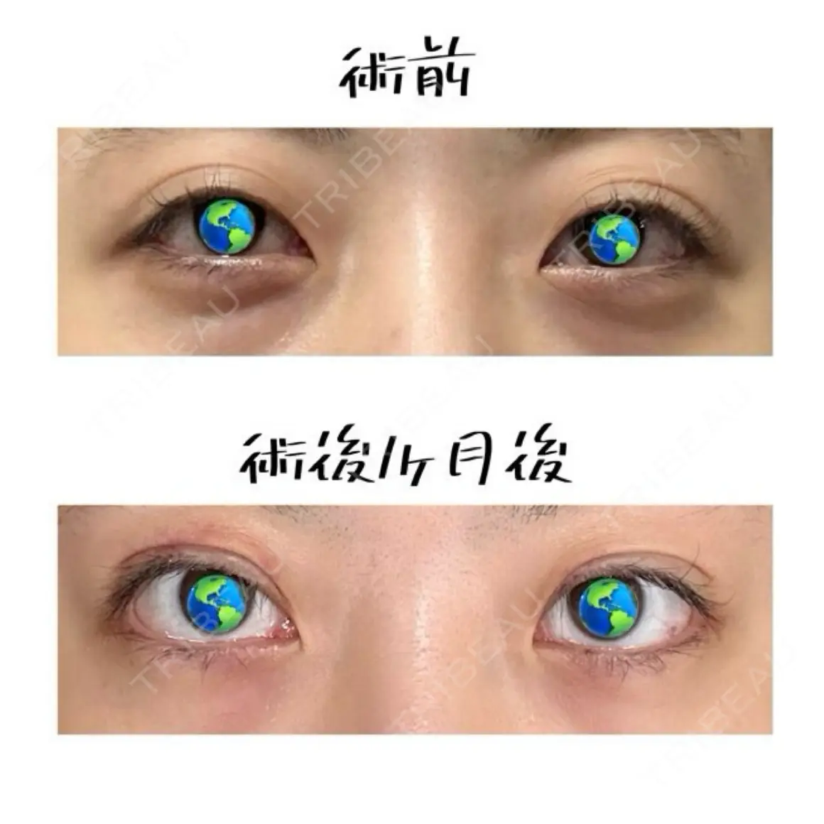 二重埋没 / 目頭切開 / 目尻切開 / タレ目形成・グラマラスライン（切開） / 眼瞼下垂（非切開） LUHO（ルホ）美容外科 AFTER