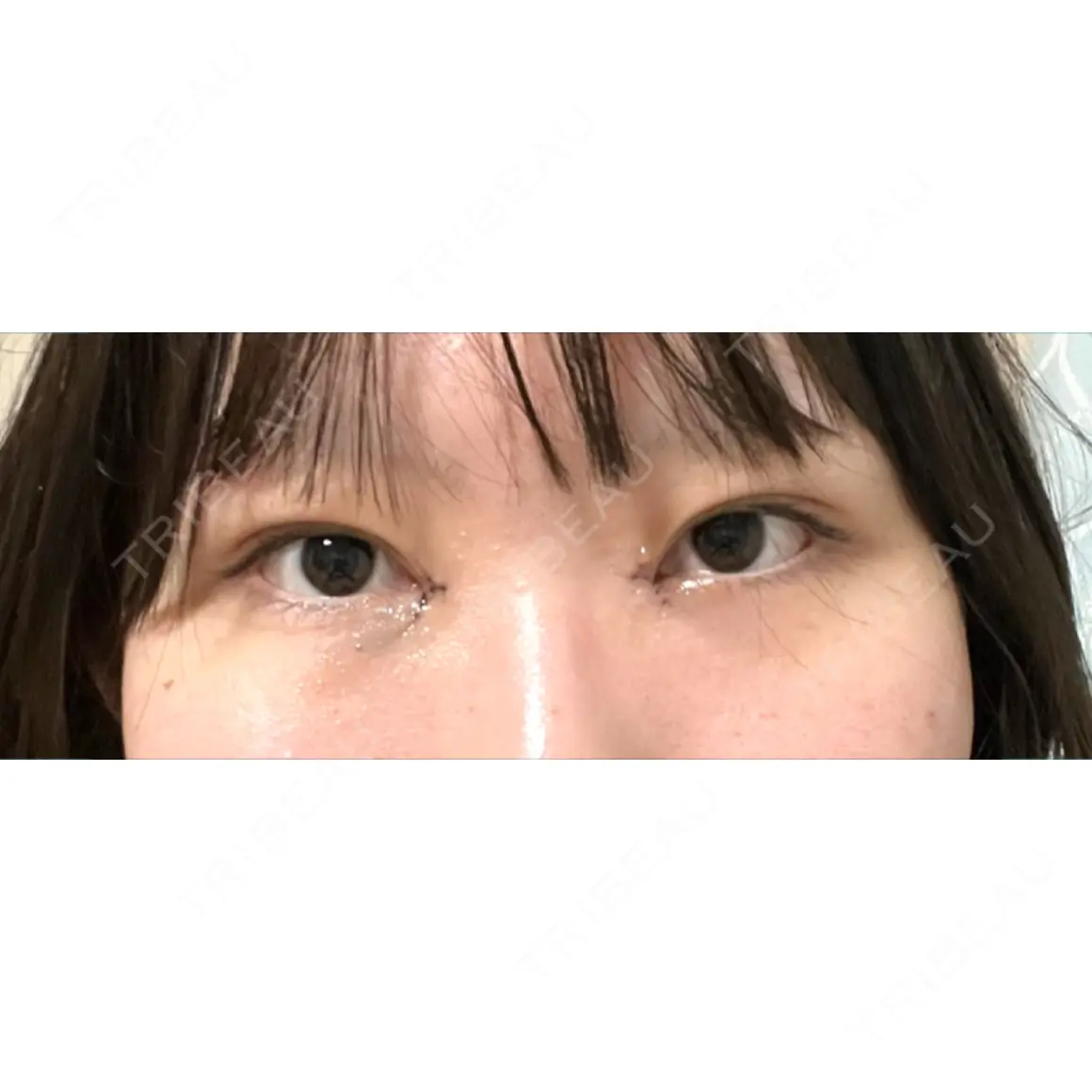 二重埋没 / 目頭切開 シンデレラ＆ダヴィンチクリニック DAY 0
