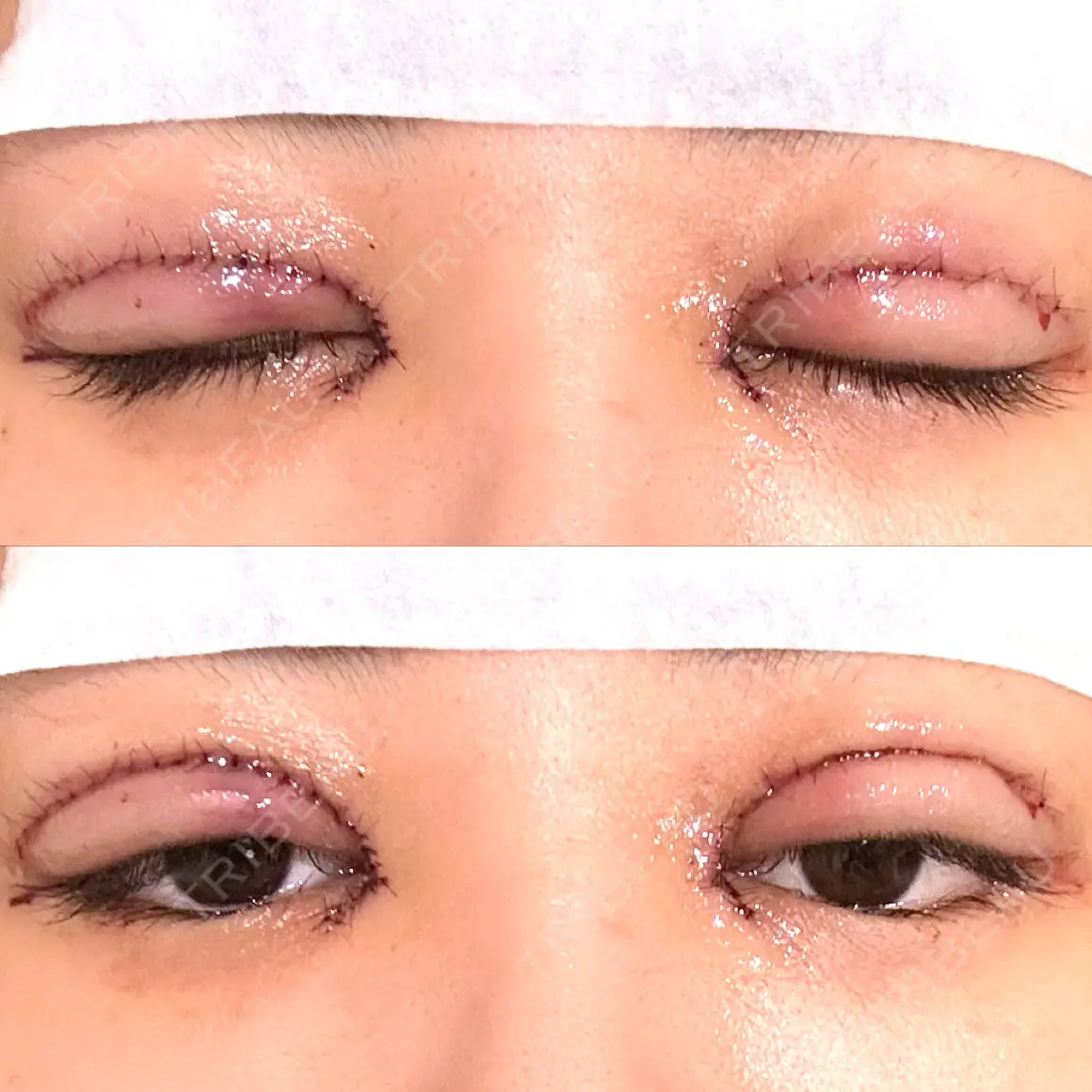 目頭切開 / 眼瞼下垂（切開） Otus Clinic 【オータスクリニック】 DAY 0