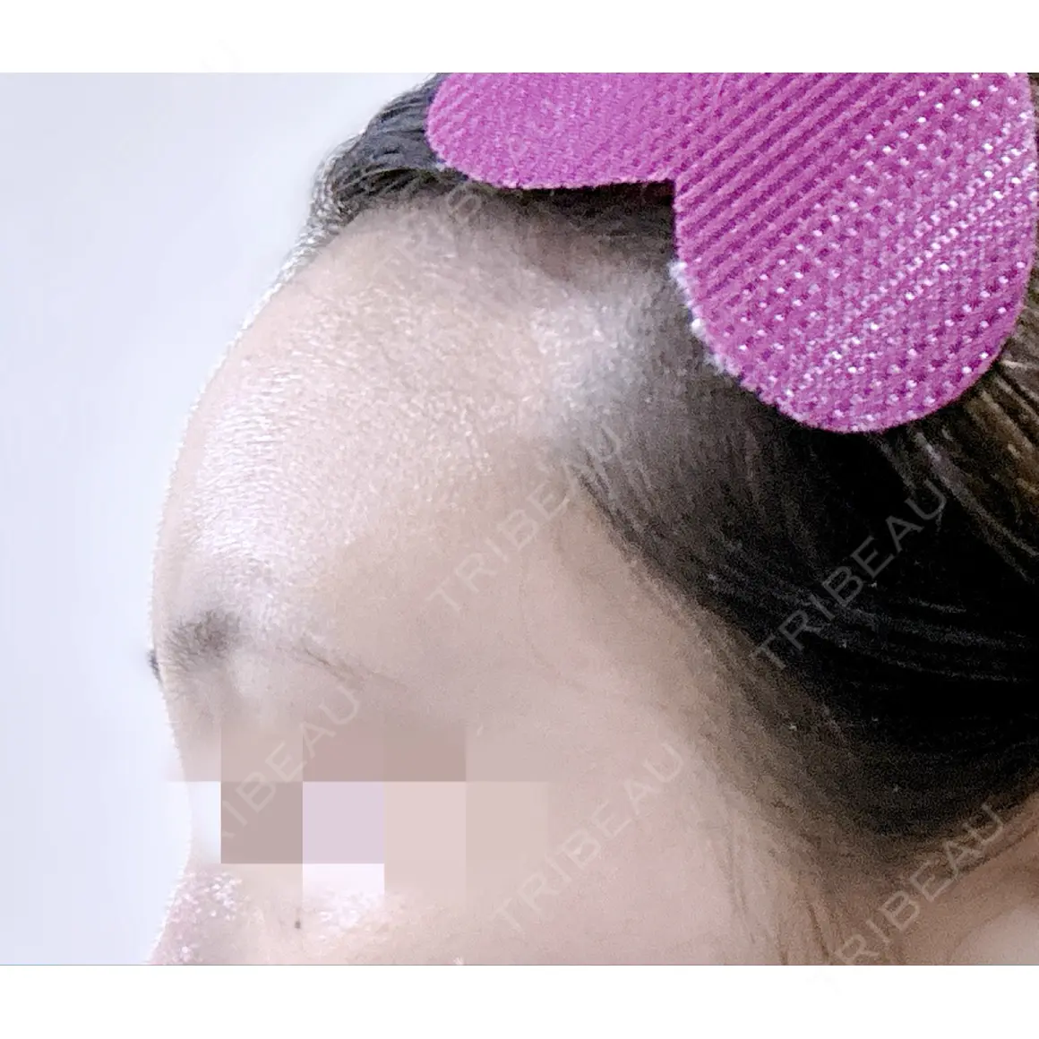 脂肪注入（肌） / 脂肪注入（額） LIBER CLINIC AFTER