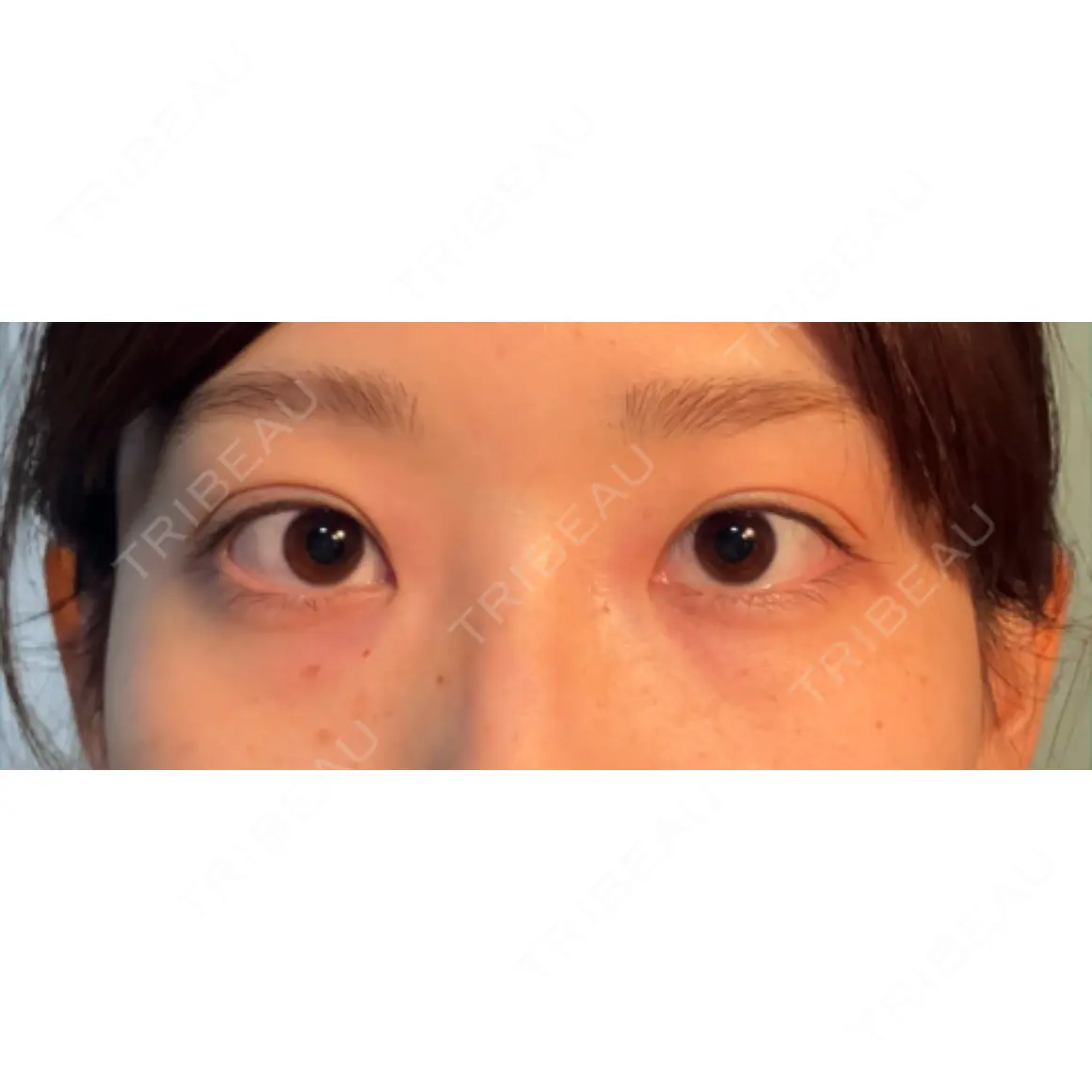 二重埋没 水の森美容クリニック 名古屋院 DAY 0