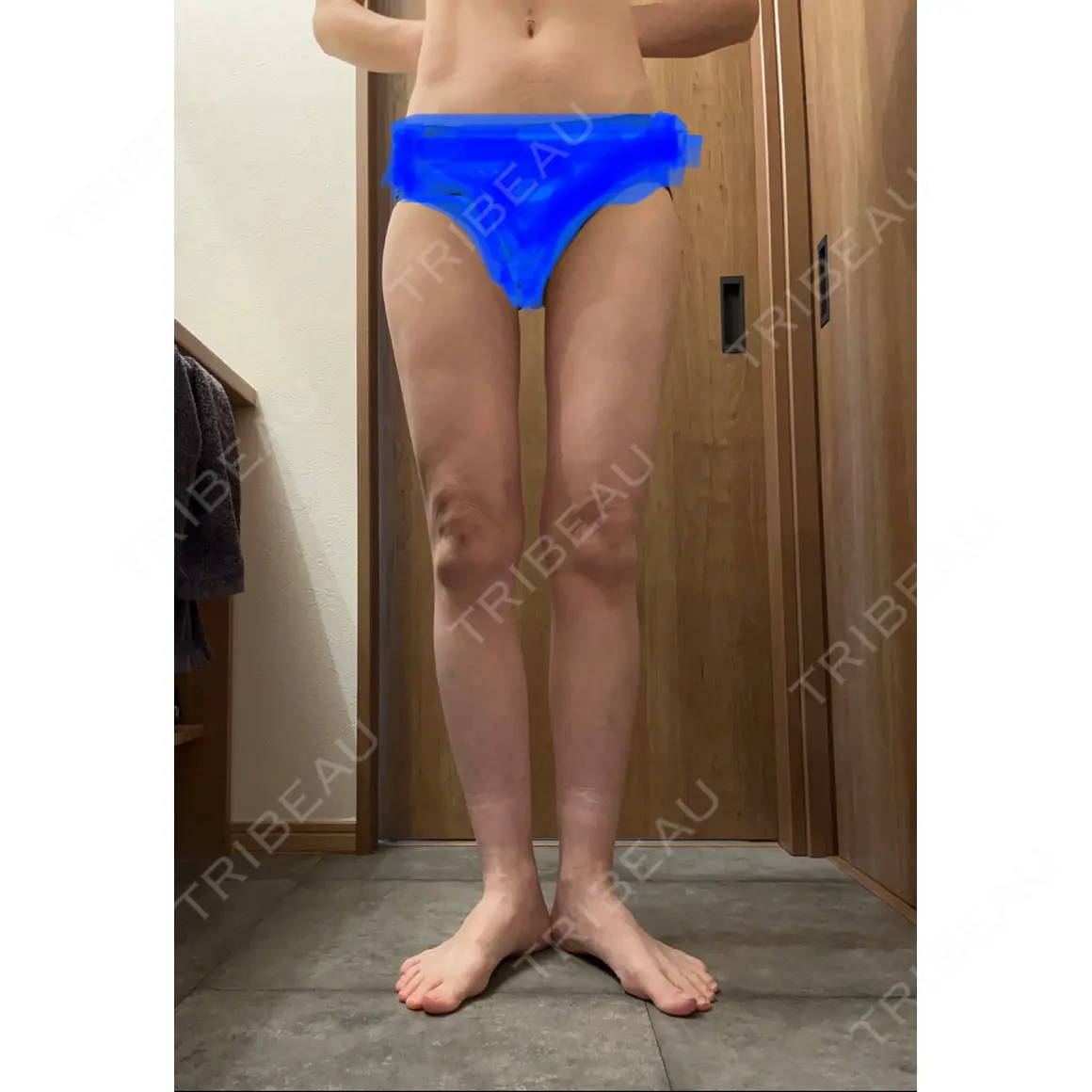 豊胸（脂肪注入） ルーチェクリニック 銀座院 AFTER