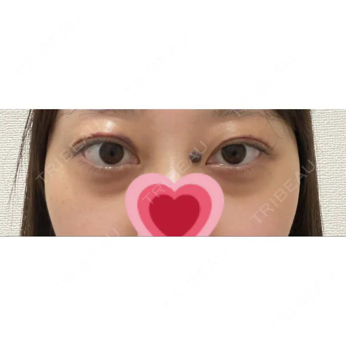 二重埋没 LUHO（ルホ）美容外科 DAY 31
