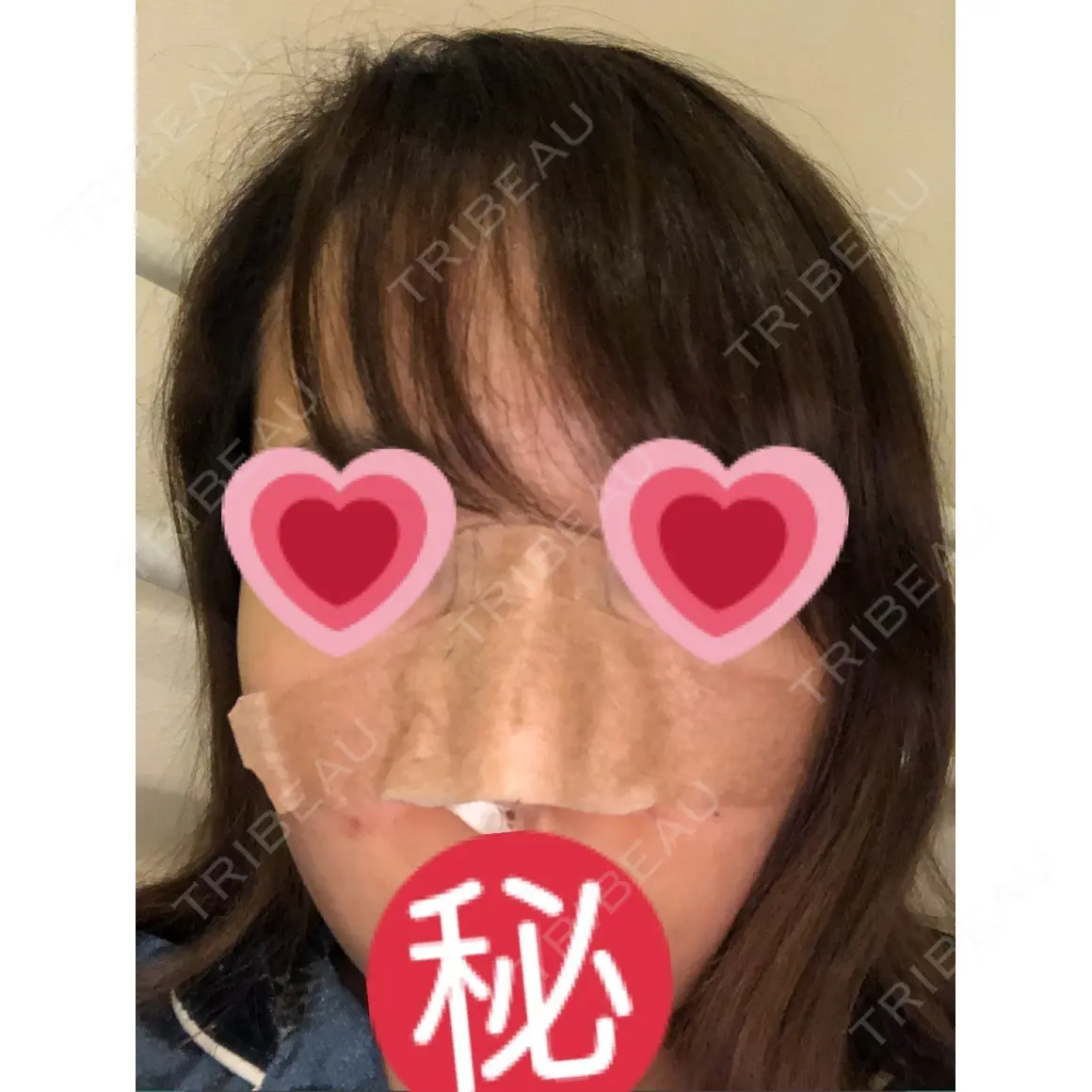 隆鼻術 湘南美容クリニック 札幌院 DAY 0