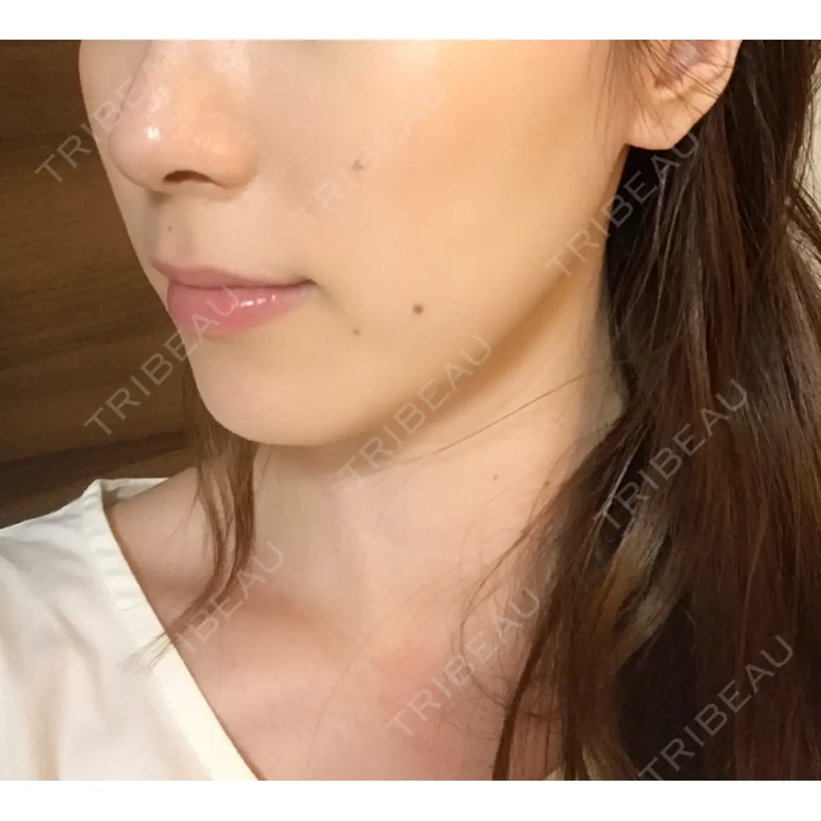 ボトックス（エラ・小顔） 湘南美容クリニック 新宿本院 AFTER
