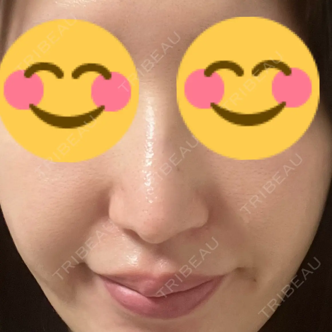 鼻尖形成（切開） / 軟骨移植 / 鼻修正 / 鼻柱下降・鼻唇角形成（猫手術） グローバルビューティークリニック 大阪院 AFTER