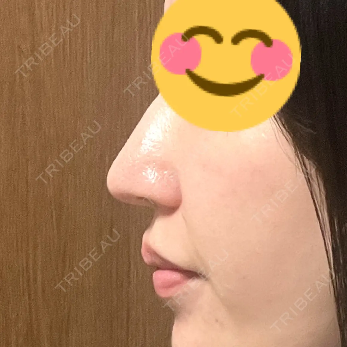 鼻尖形成（切開） / 軟骨移植 / 鼻修正 / 鼻柱下降・鼻唇角形成（猫手術） グローバルビューティークリニック 大阪院 AFTER