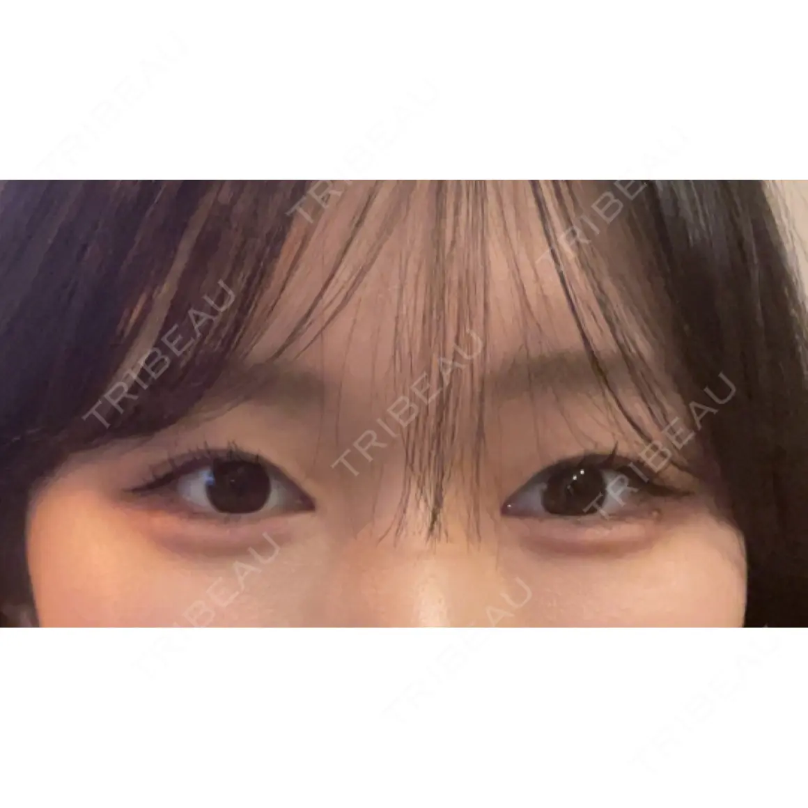 ヒアルロン酸注入（涙袋） / ヒアルロン酸注入（唇） 銀座美容外科クリニック 銀座院 AFTER