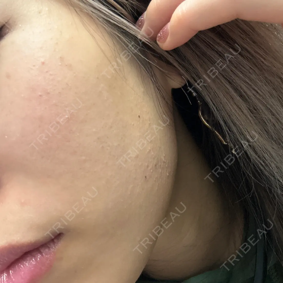 イオン導入 / 光治療（フォトフェイシャルなど） ルラ美容クリニック 町田院 AFTER