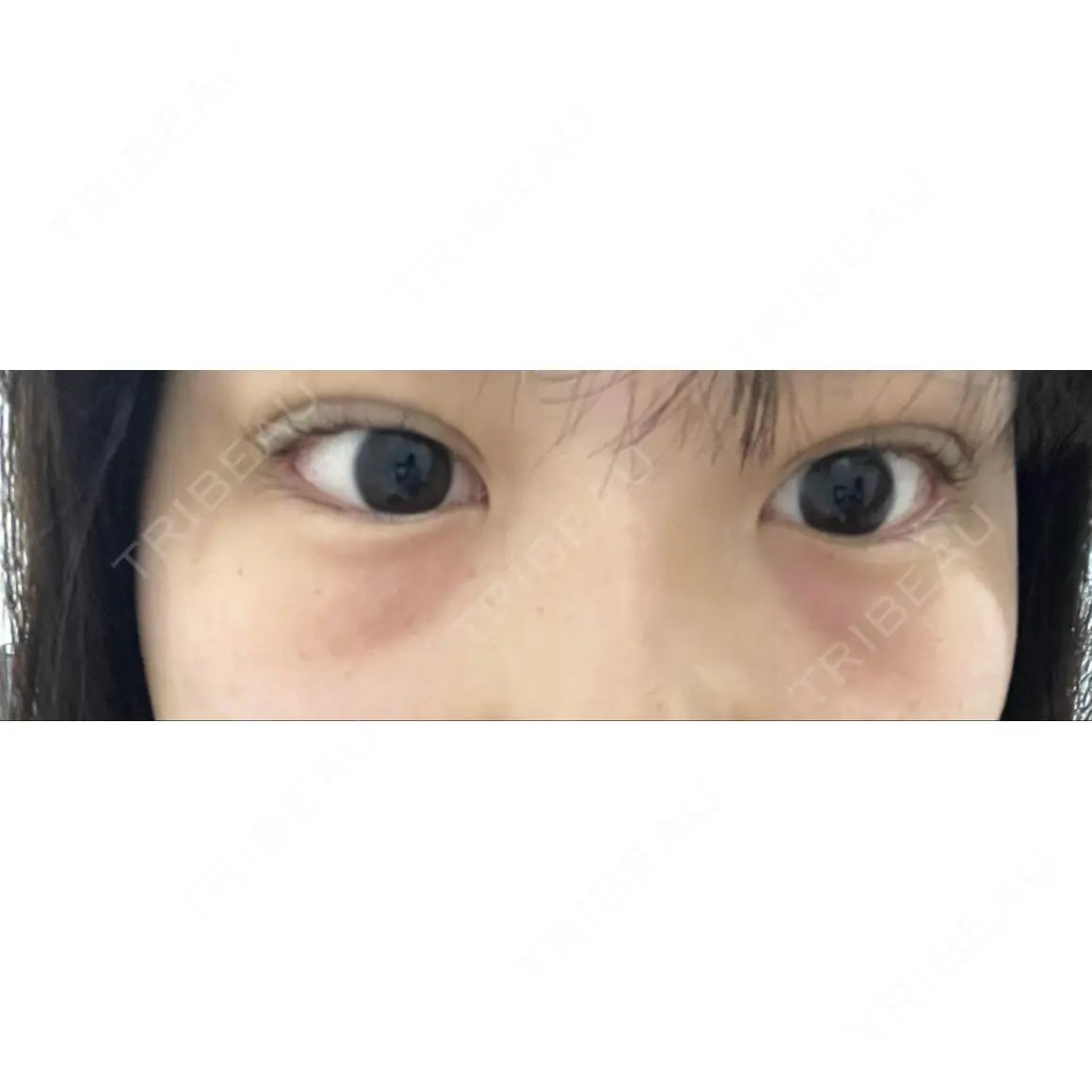 二重埋没 / 上まぶたの脂肪取り HAAB×DREAM BEAUTY CLINIC 東京本院 DAY 0