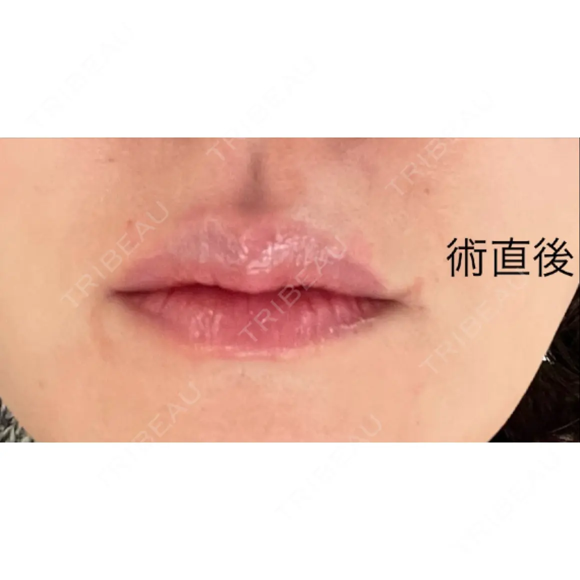 ヒアルロン酸注入（唇） / ボトックス（口角） ルラ美容クリニック 福岡院 DAY 0