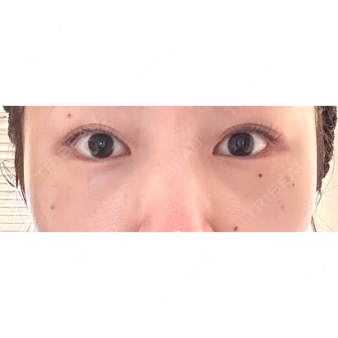 クマ治療 X CLINIC 銀座院 AFTER
