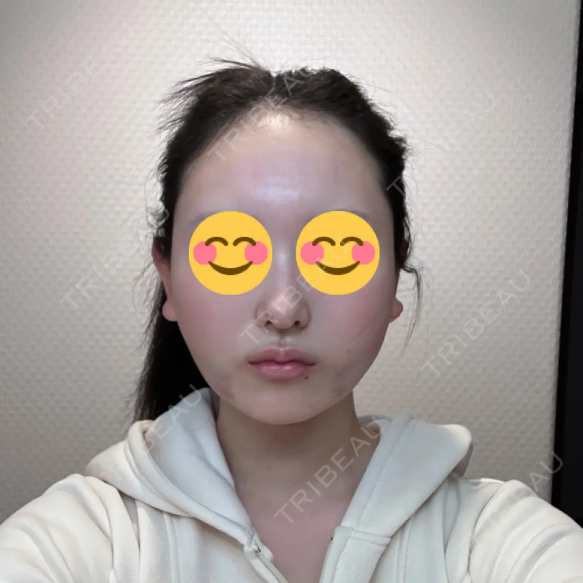 糸リフト / 脂肪吸引（顔） ブルームクリニック（BLOOM CLINIC） DAY 0