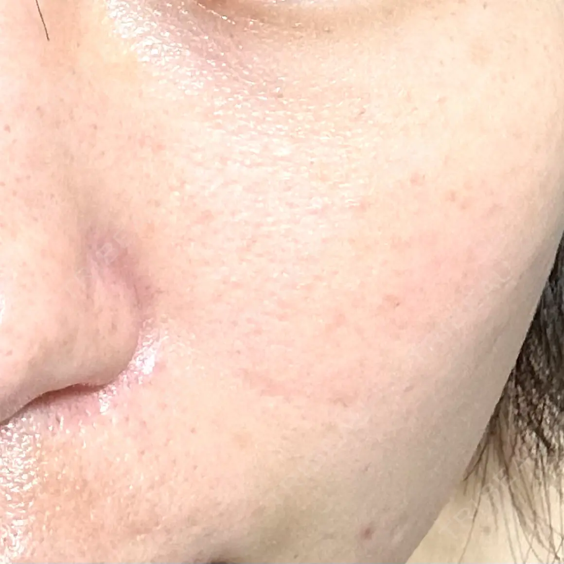光治療（フォトフェイシャルなど） B-LINE CLINIC 池袋院 AFTER
