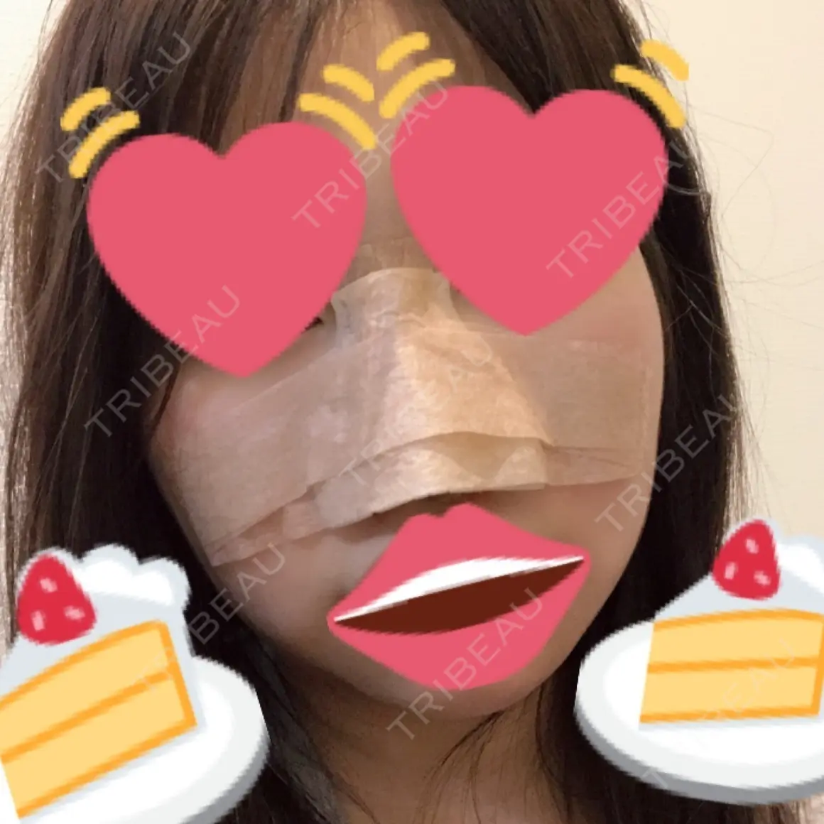 隆鼻術 湘南美容クリニック 札幌院 DAY 0