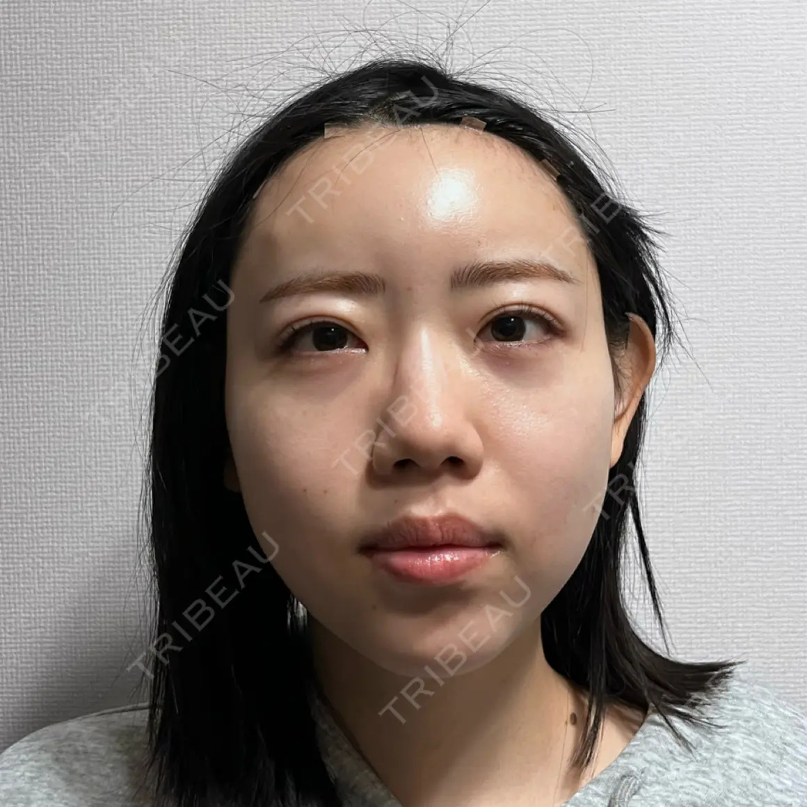 脂肪吸引（脚） / 脂肪吸引（お尻） / 脂肪注入（額） 湘南美容クリニック 京都院 DAY 0