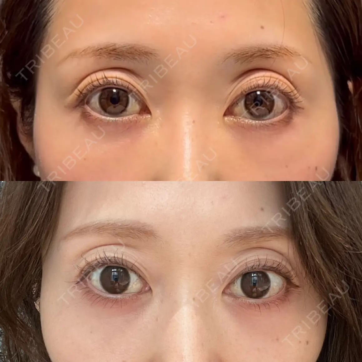クマ治療 X CLINIC 銀座院 AFTER