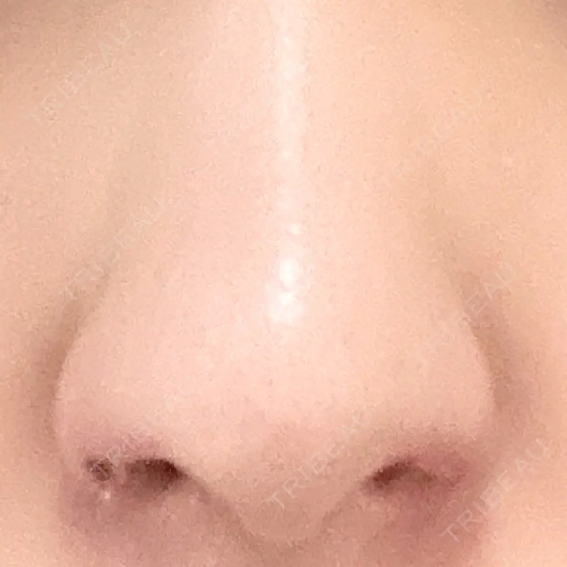 鼻孔縁挙上 大阪TAクリニック AFTER