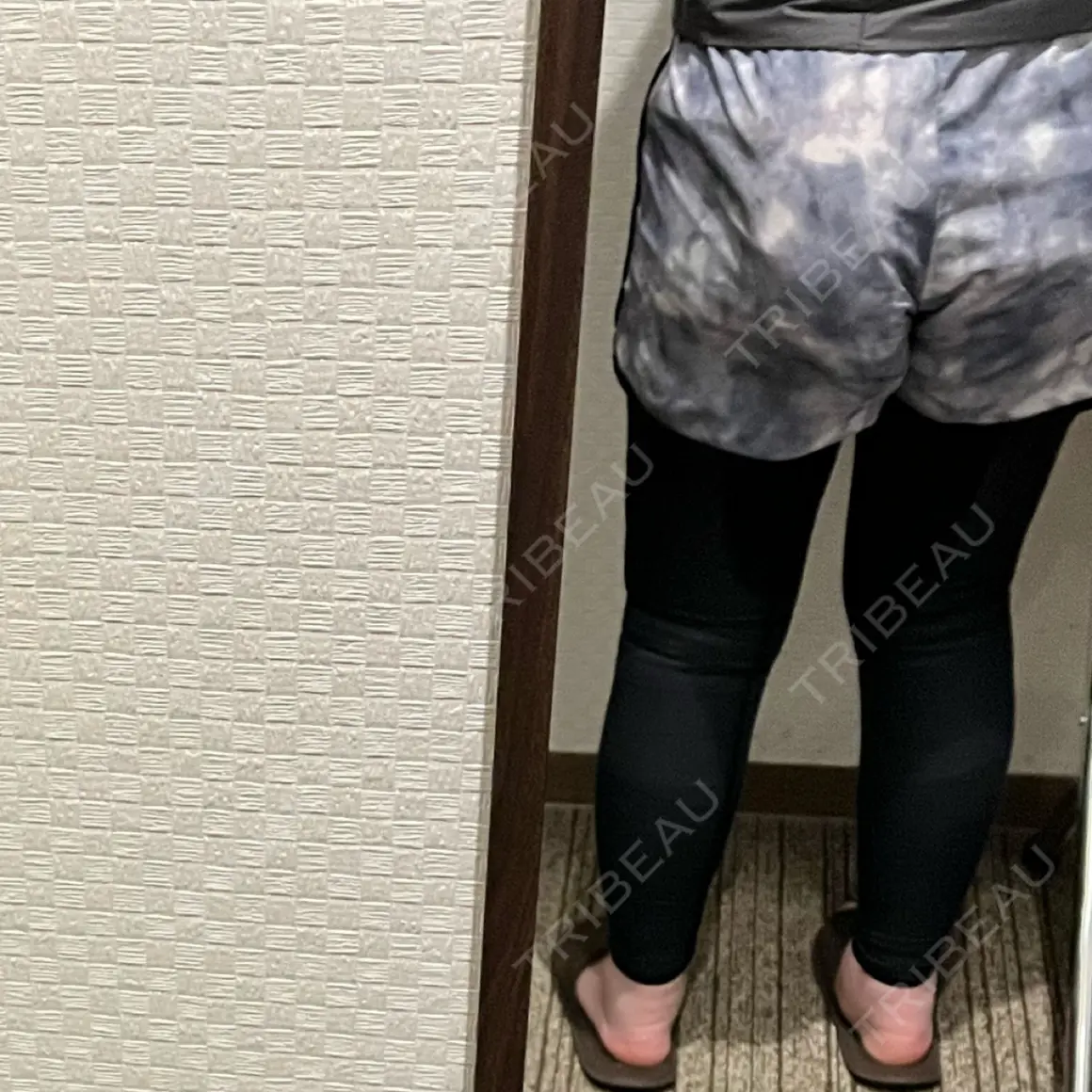 脂肪吸引（脚） / 脂肪吸引（お尻） 湘南美容クリニック 京都院 DAY 1