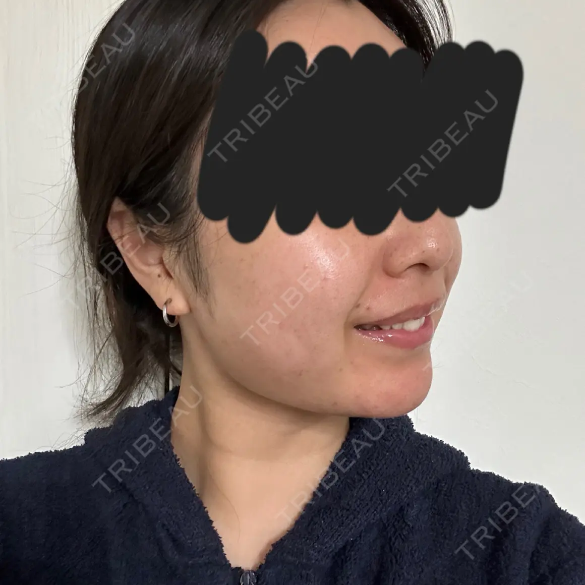 糸リフト / バッカルファット除去 / 脂肪吸引（顔） / メーラーファット除去 / 脂肪吸引注射（顔） SEA CLINIC（シークリニック） AFTER