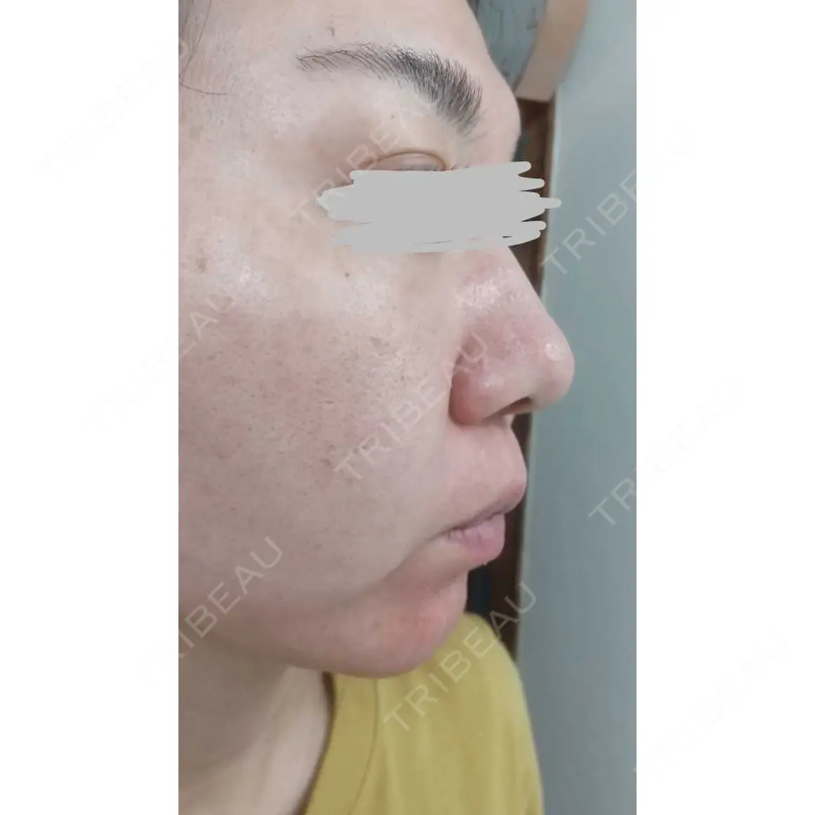 ポテンツァ 9BeautyClinic AFTER