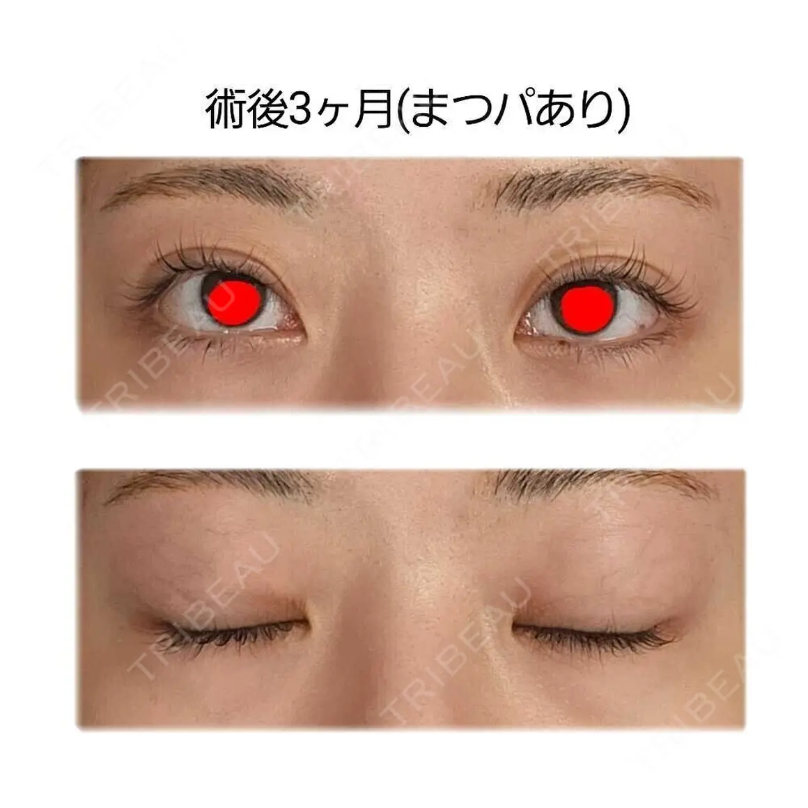 二重埋没 / 目頭切開 / 目尻切開 / タレ目形成・グラマラスライン（切開） / 眼瞼下垂（非切開） LUHO（ルホ）美容外科 AFTER