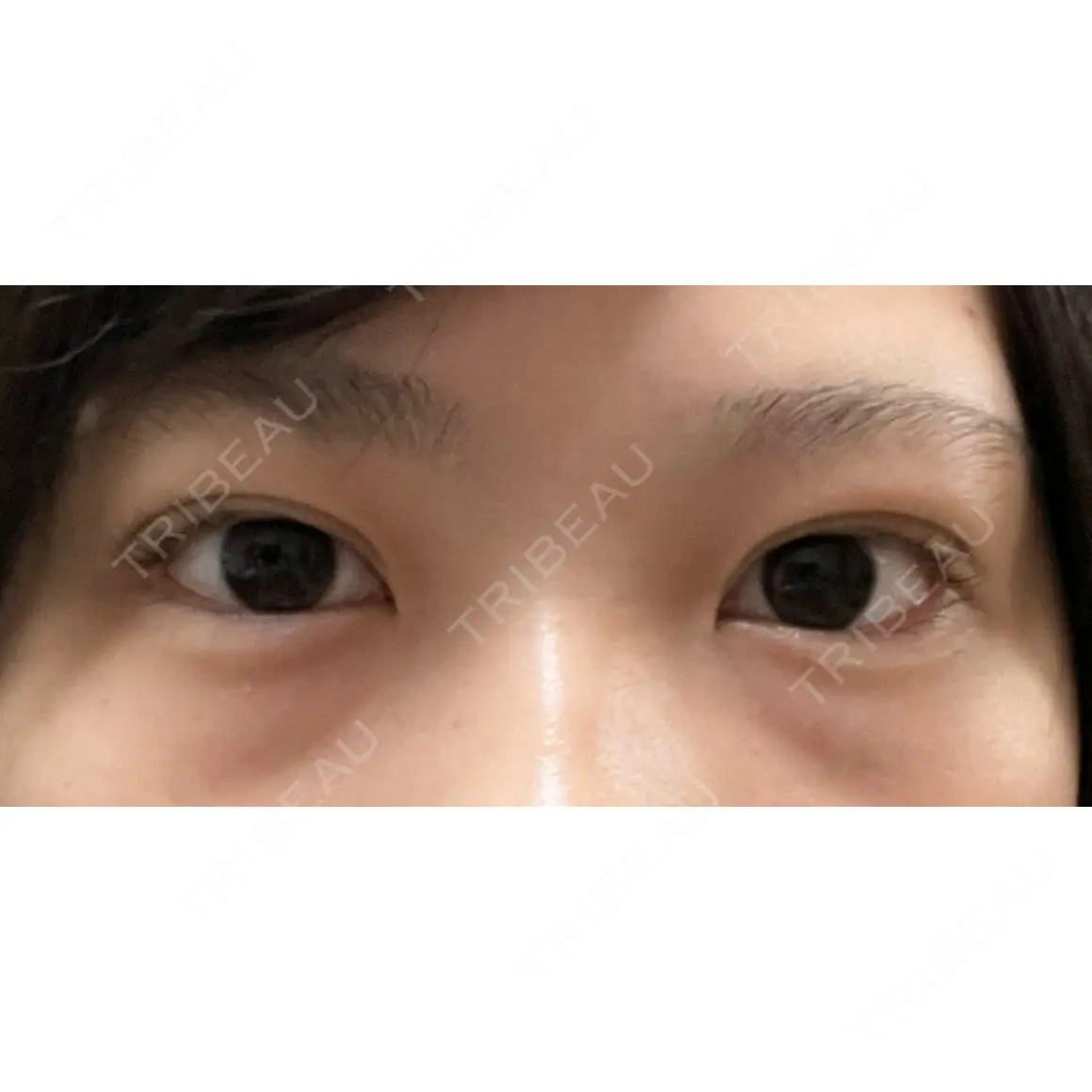 二重埋没 / 上まぶたの脂肪取り HAAB×DREAM BEAUTY CLINIC 東京本院 AFTER