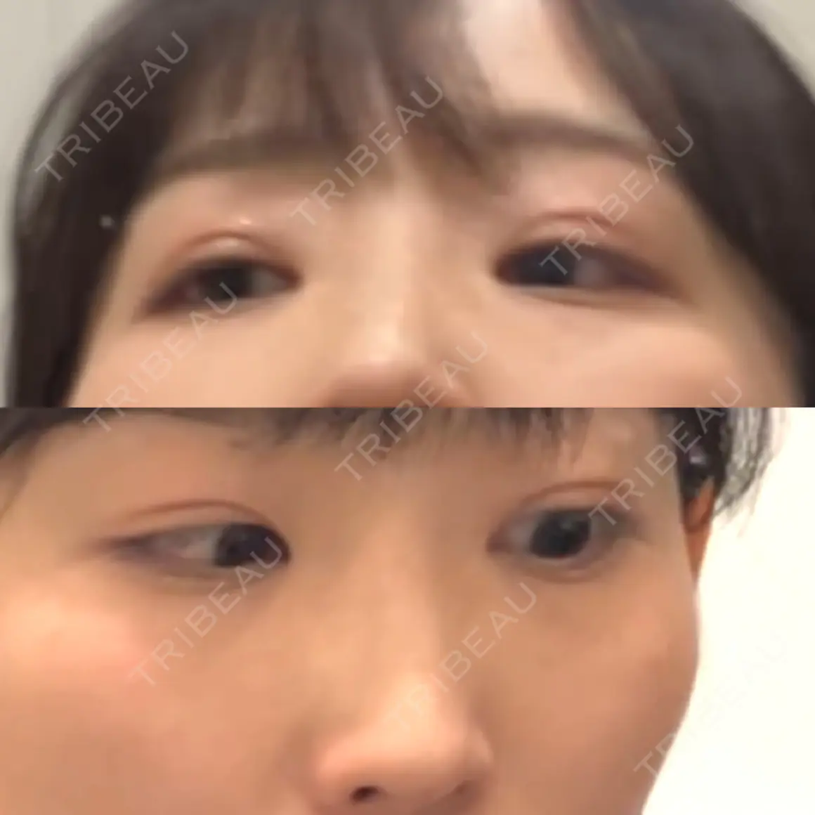 二重埋没 水の森美容クリニック 名古屋院 AFTER