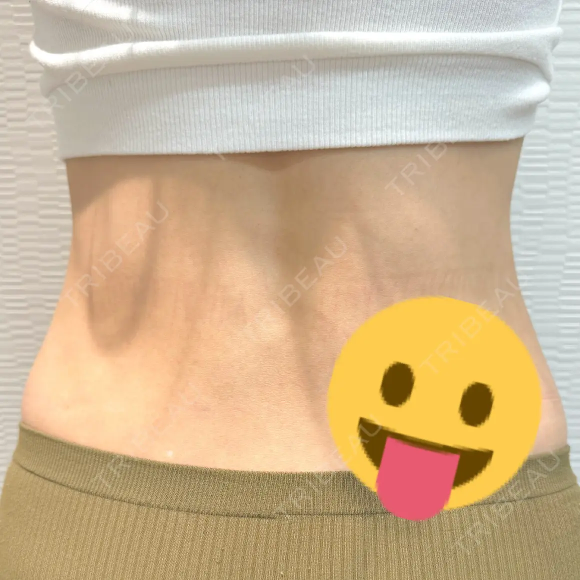 脂肪吸引（お腹） / 脂肪吸引（腰） Mods Clinic（モッズクリニック） 大阪院 AFTER