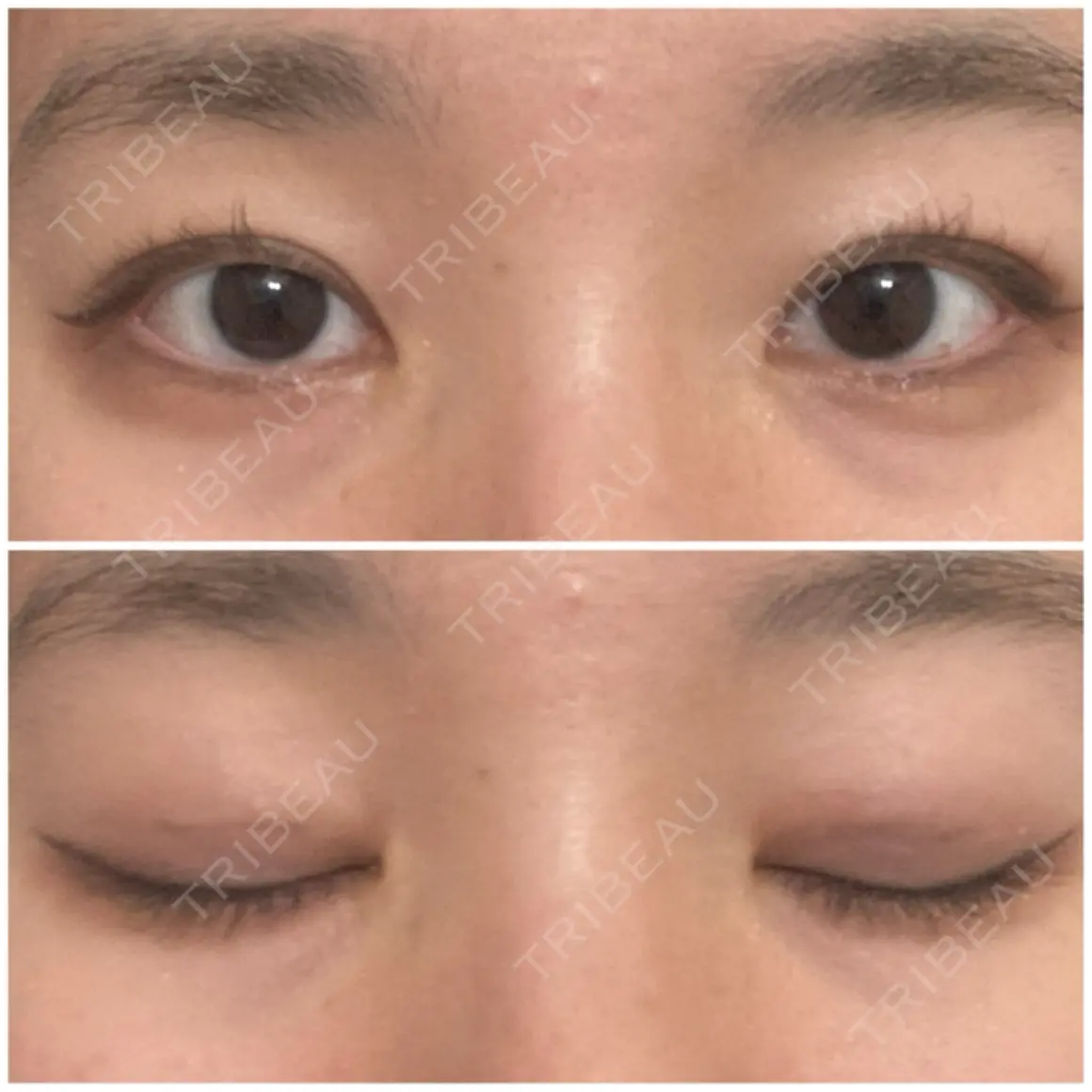 二重埋没 オアシス美容外科 AFTER