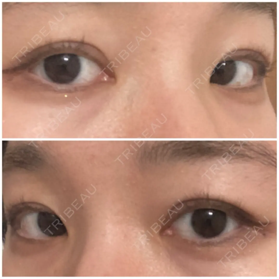 二重埋没 オアシス美容外科 AFTER