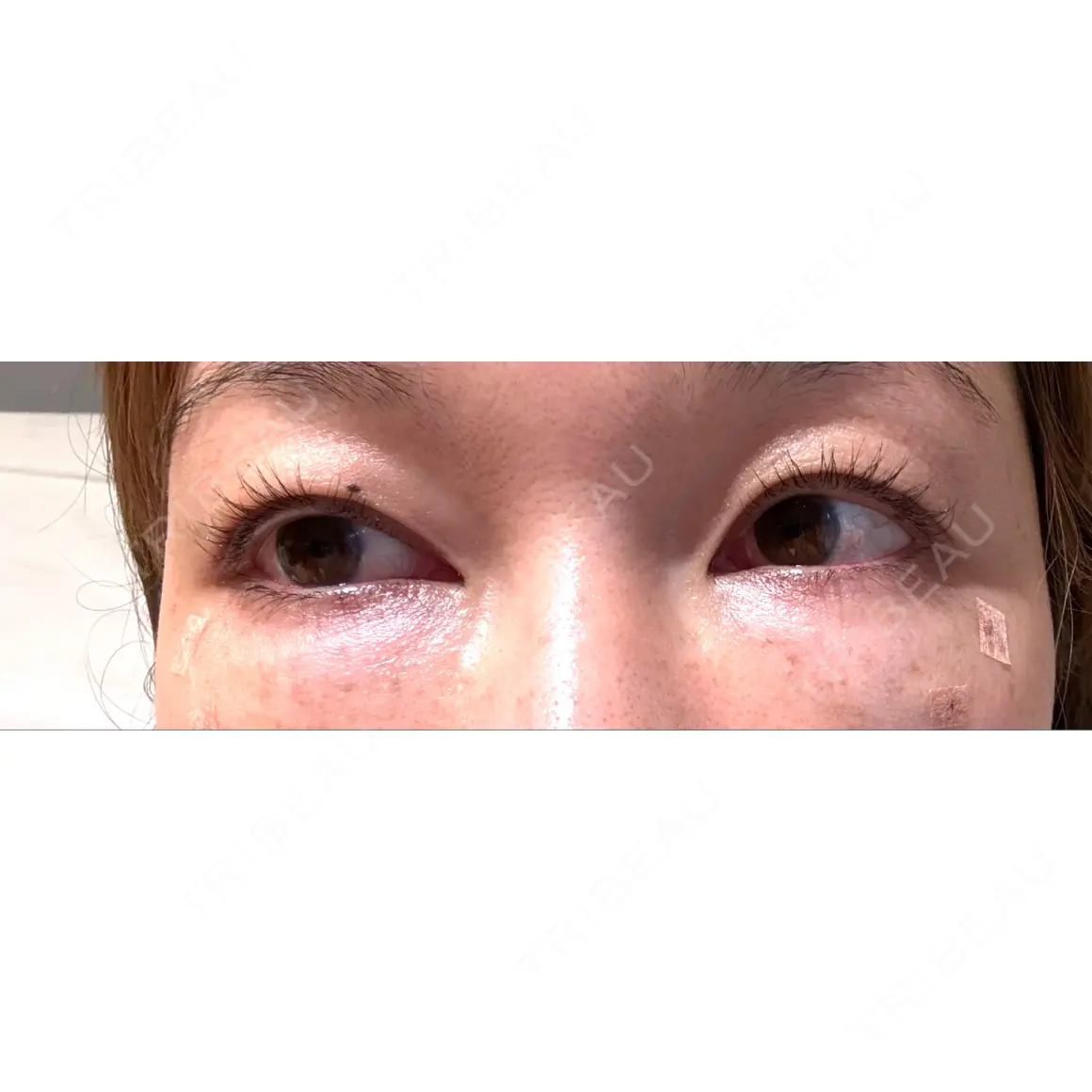 クマ治療 X CLINIC 銀座院 DAY 0