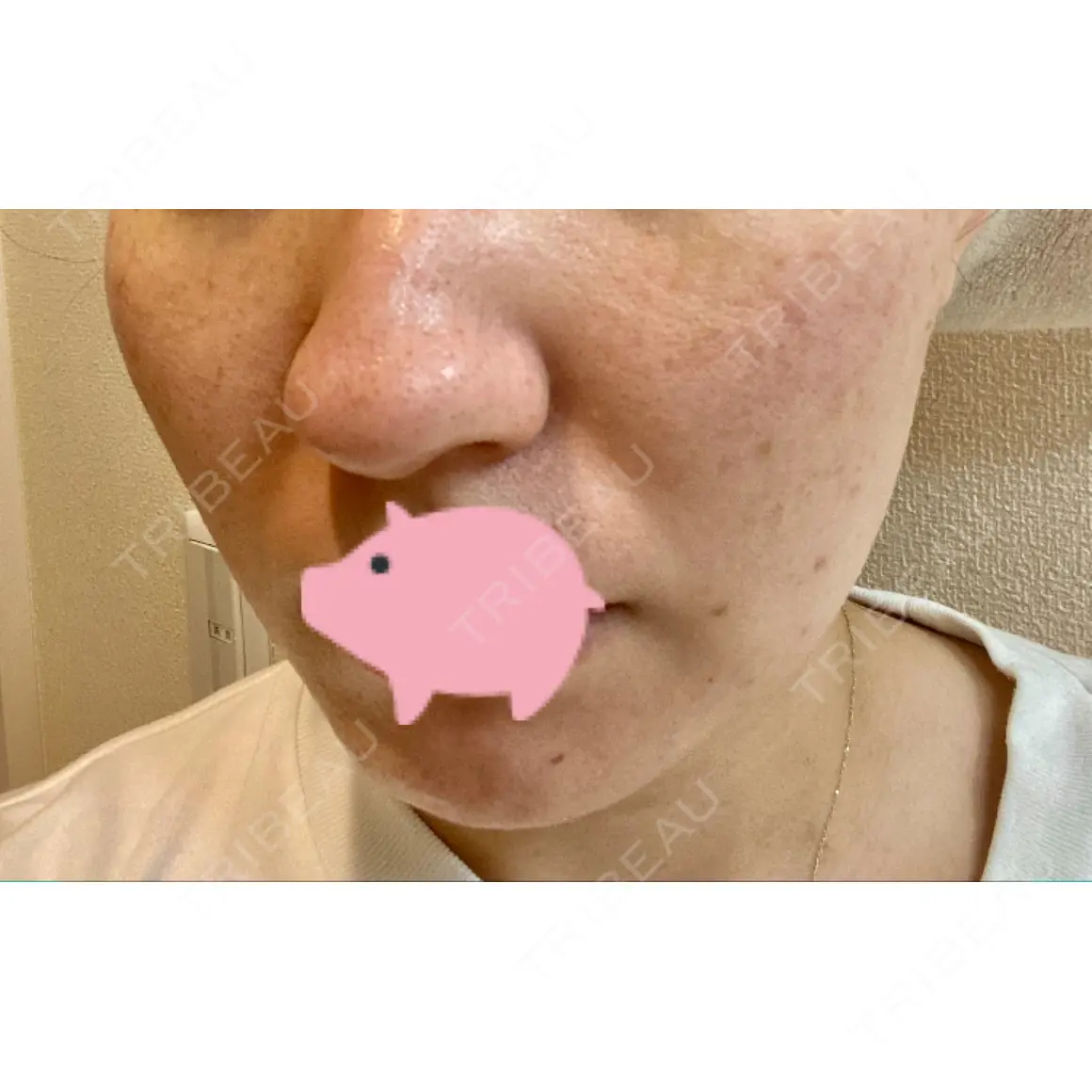 エレクトロポレーション / 毛穴洗浄（ハイドラフェイシャルなど） / 光治療（フォトフェイシャルなど） B-LINE CLINIC 池袋院 AFTER